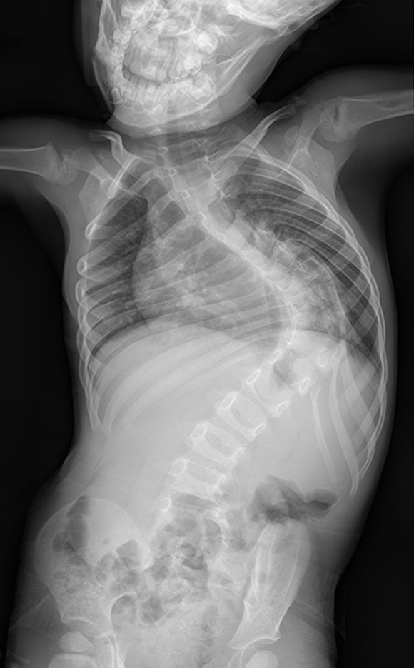 Outcomes Of Growing Rod Surgery For Severe Compared With Moderate Early