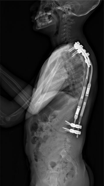 Outcomes Of Growing Rod Surgery For Severe Compared With Moderate Early