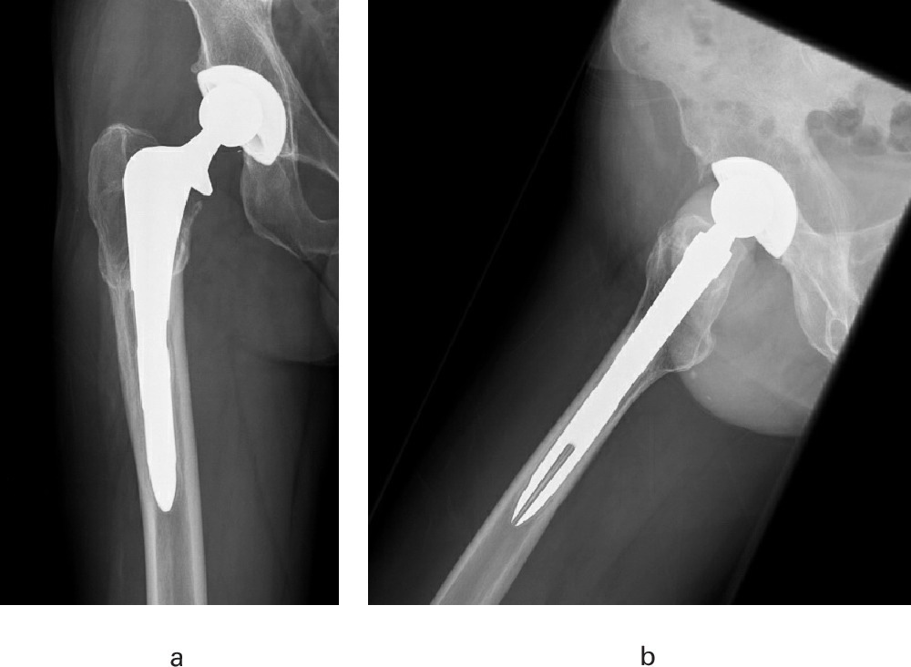 Fig. 1 
          a) Anteroposterior and b) lateral radiograph of the right hip of a 58-year-old male patient 13 years after primary total hip arthroplasty demonstrating the asymmetrical polyethylene wear, an indication for exchange of the acetabular liner.
        