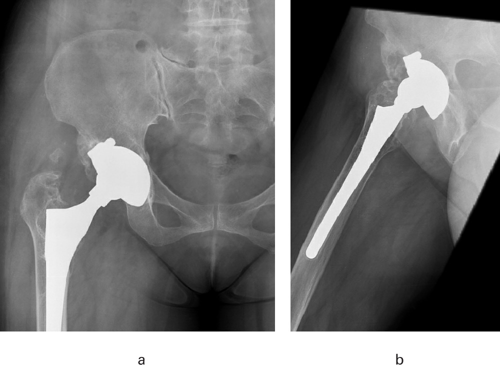 Fig. 2 
          a) Anteroposterior and b) lateral radiograph of the right hip of a 58-year-old male patient one month following revision surgery with highly crosslinked polyethylene acetabular liner fixed with cement.
        