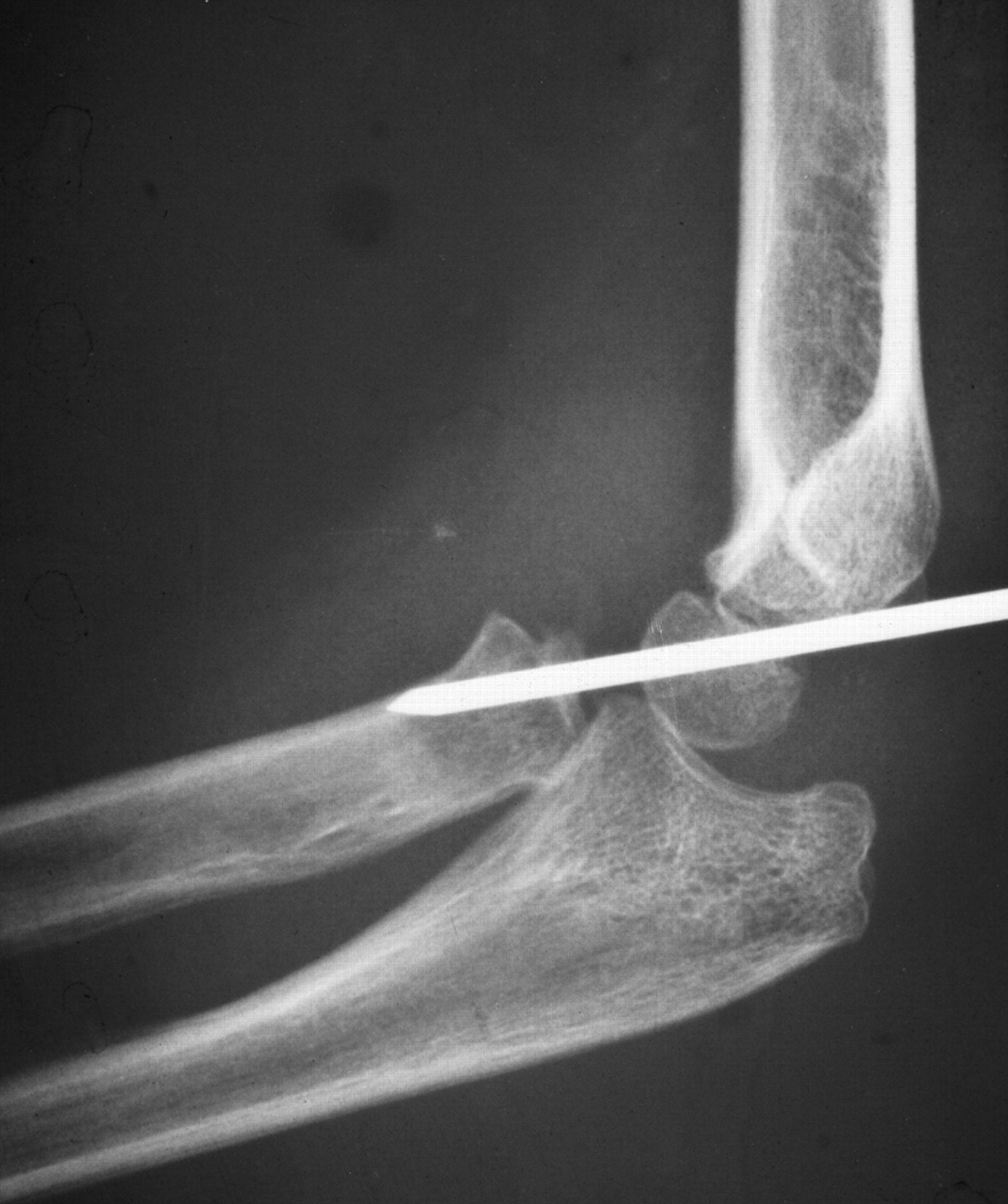 Open Reduction Ulnar Osteotomy And External Fixation For Chronic