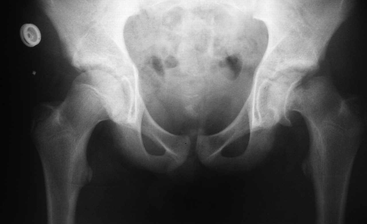 The Management Of Avascular Necrosis After Slipped Capital Femoral