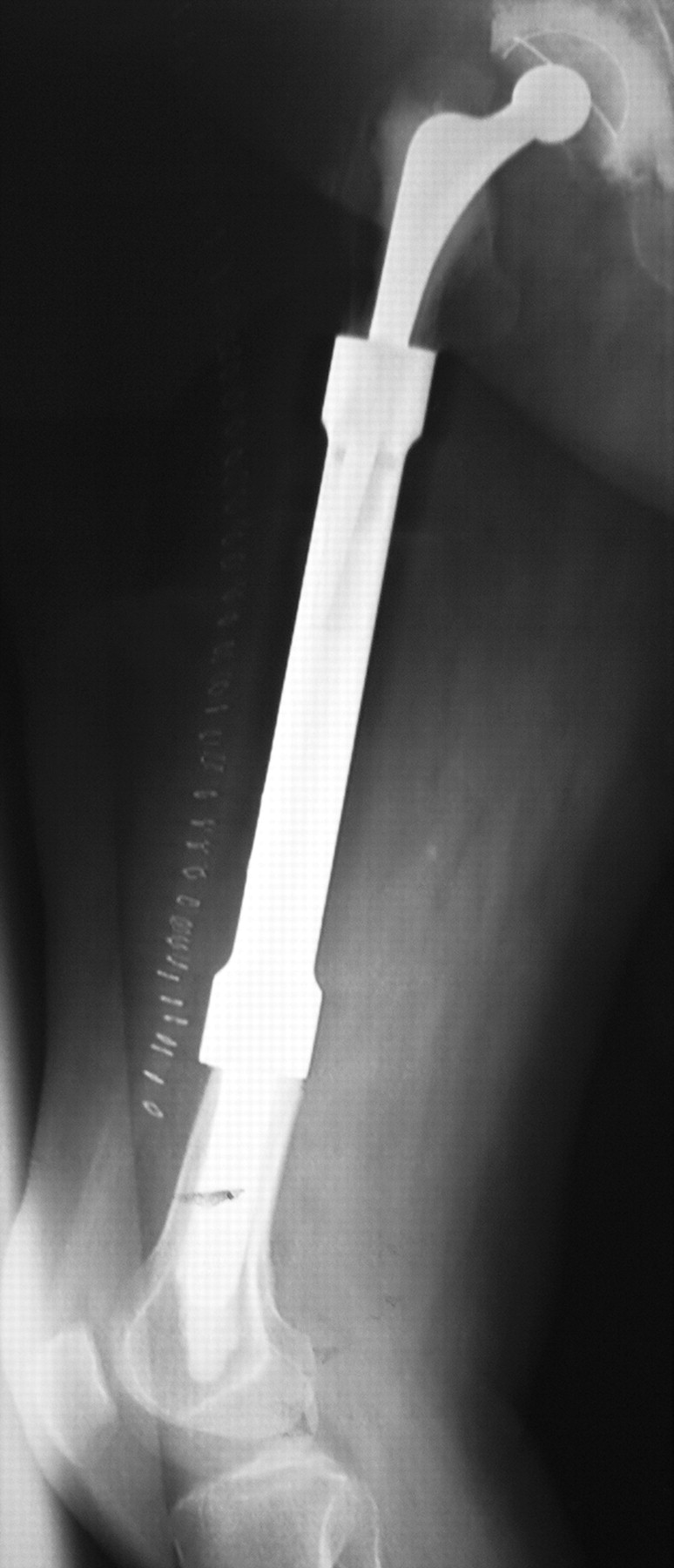 A Custom Made Prosthesis Attached To An Existing Femoral Component For