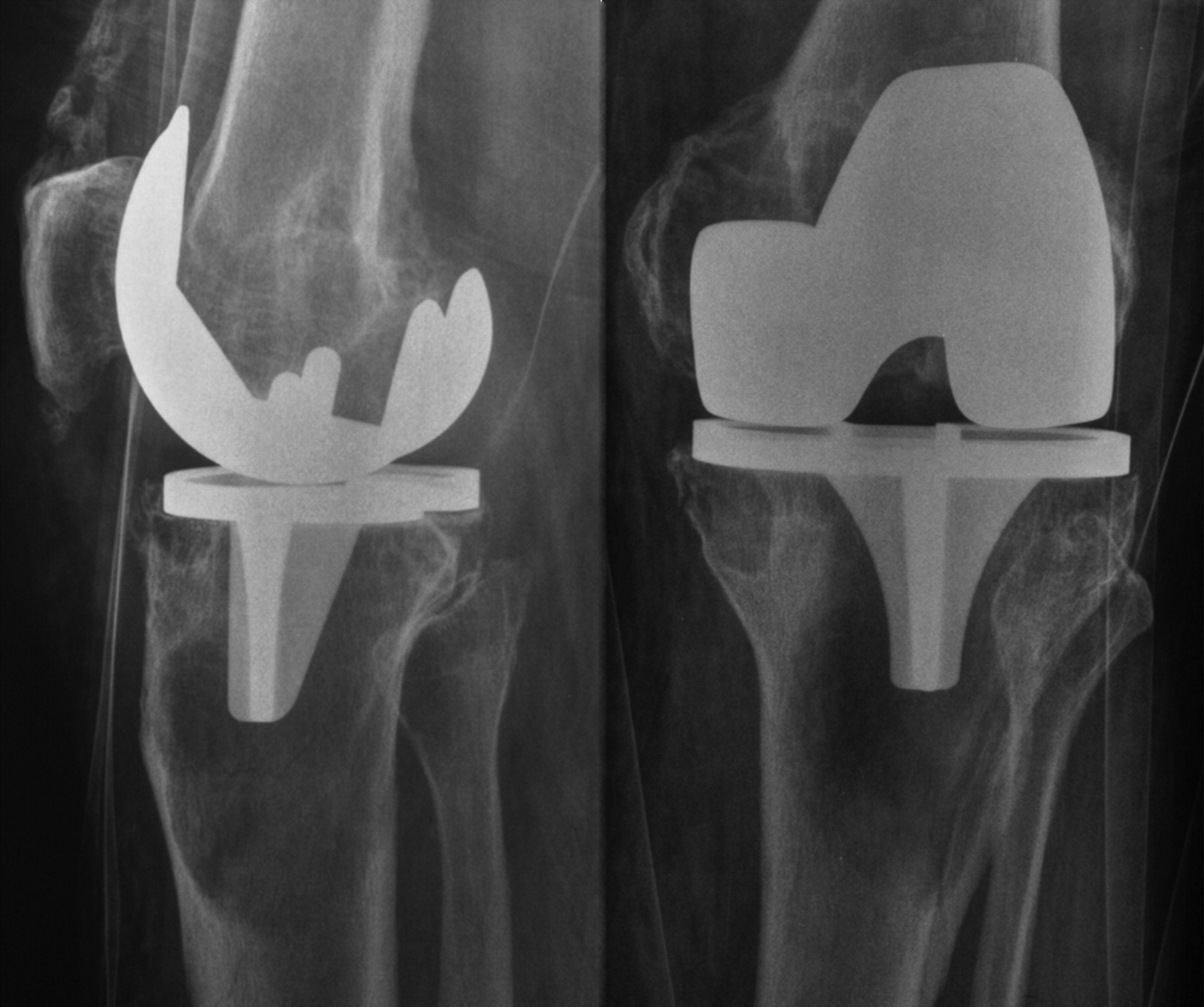 A Randomised Controlled Trial Of Cemented Versus Cementless Press Fit