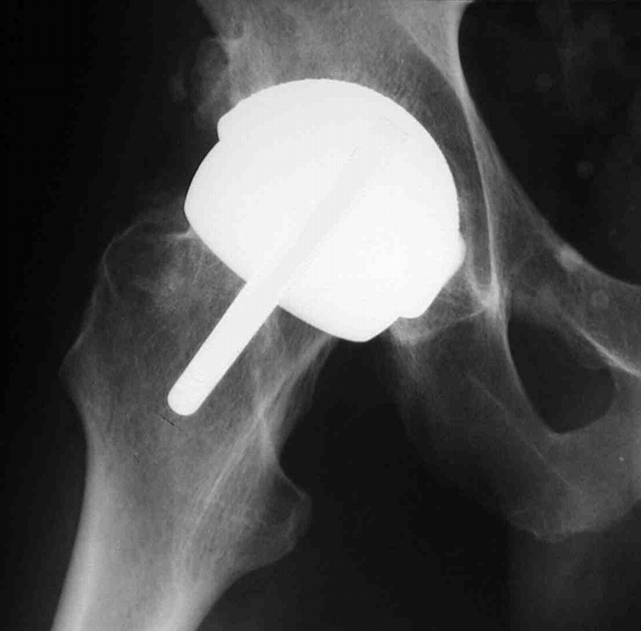 Metal Ion Levels In A Triathlete With A Metal On Metal Resurfacing