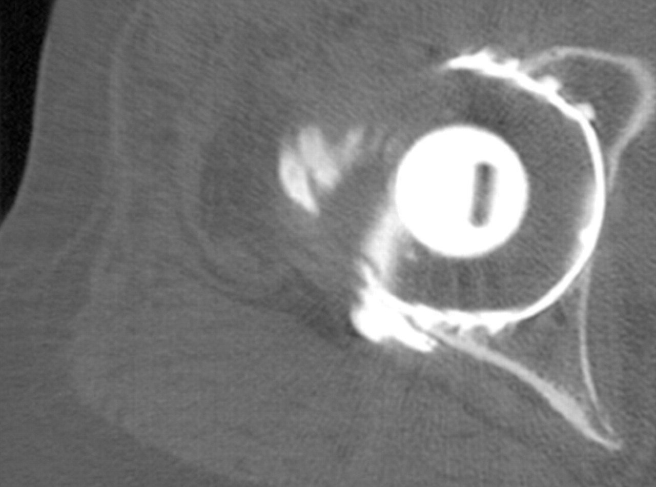 Iliopsoas Impingement After Total Hip Replacement Bone Joint