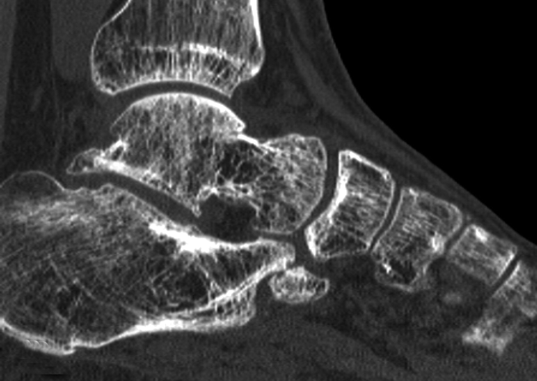 Arthroscopic Release For Painful Subtalar Stiffness After Intra