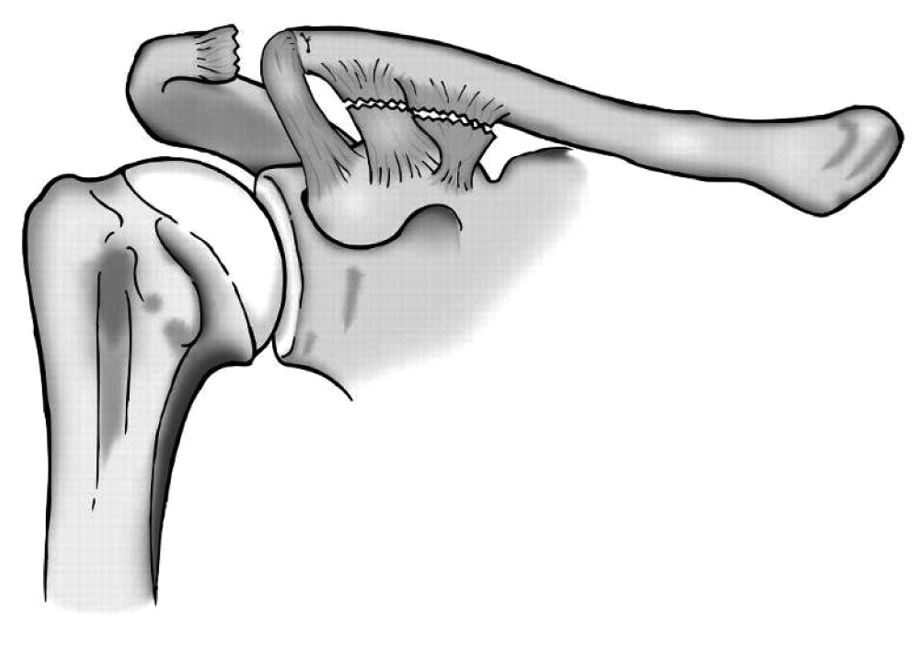 Injuries To The Acromioclavicular Joint Bone Joint