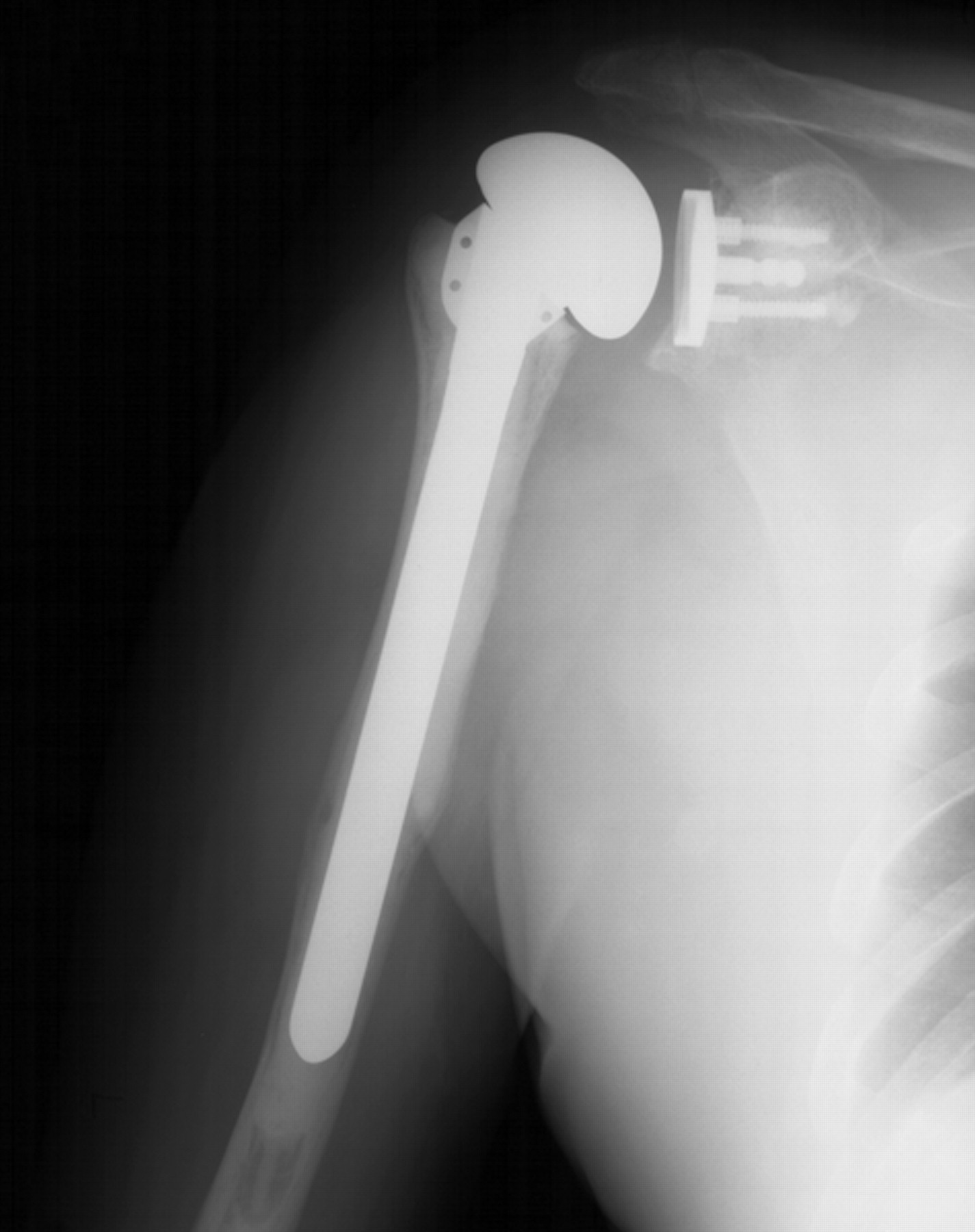 Revision Of The Humeral Component For Aseptic Loosening In Arthroplasty