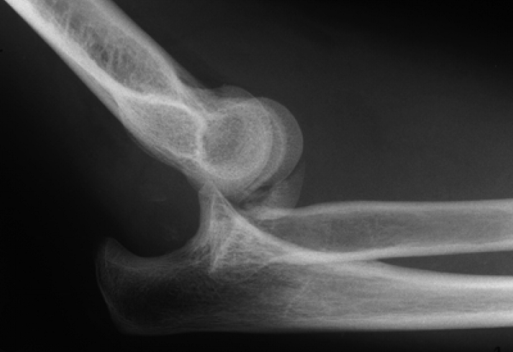 Mason Type Iv Fractures Of The Elbow Bone Joint