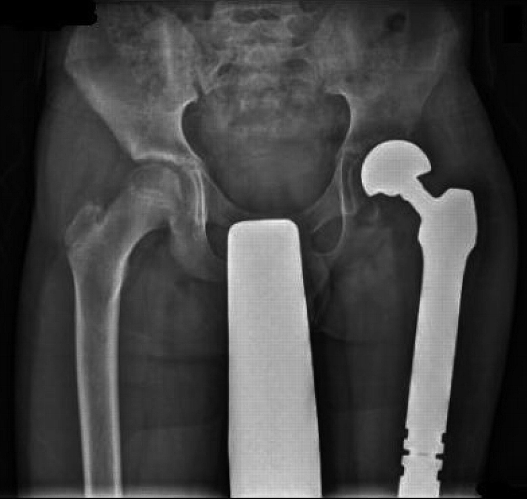 Total Femoral Endoprosthetic Replacement Following Excision Of Bone