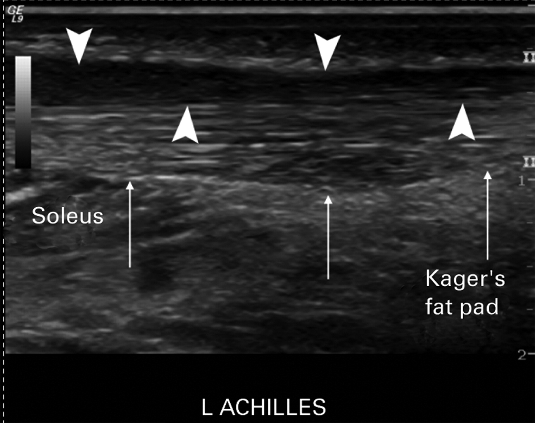 The Use Of Ultrasound In The Assessment And Treatment Of Achilles Tendinosis Bone Joint