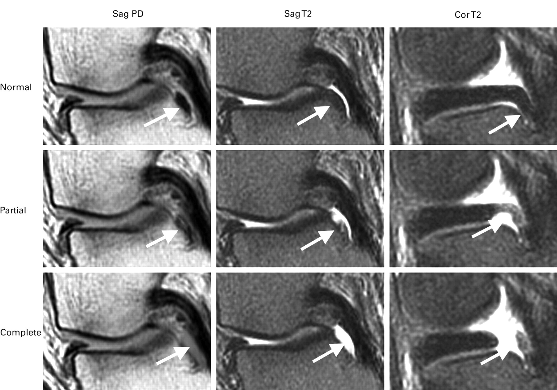 Meniscal Root Injury And Spontaneous Osteonecrosis Of The Knee Bone