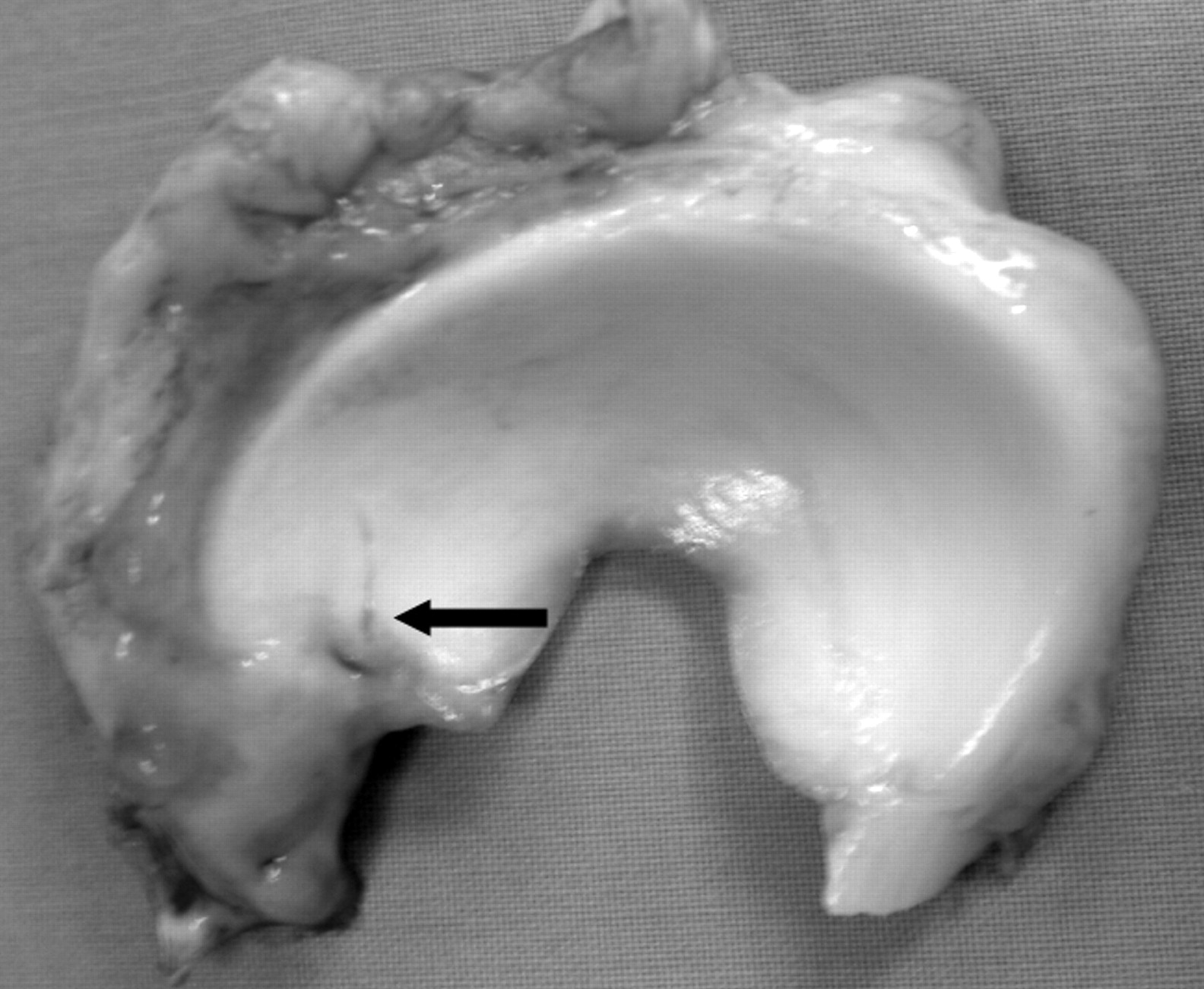 Enhancement Of Meniscal Repair In The Avascular Zone Using Mesenchymal