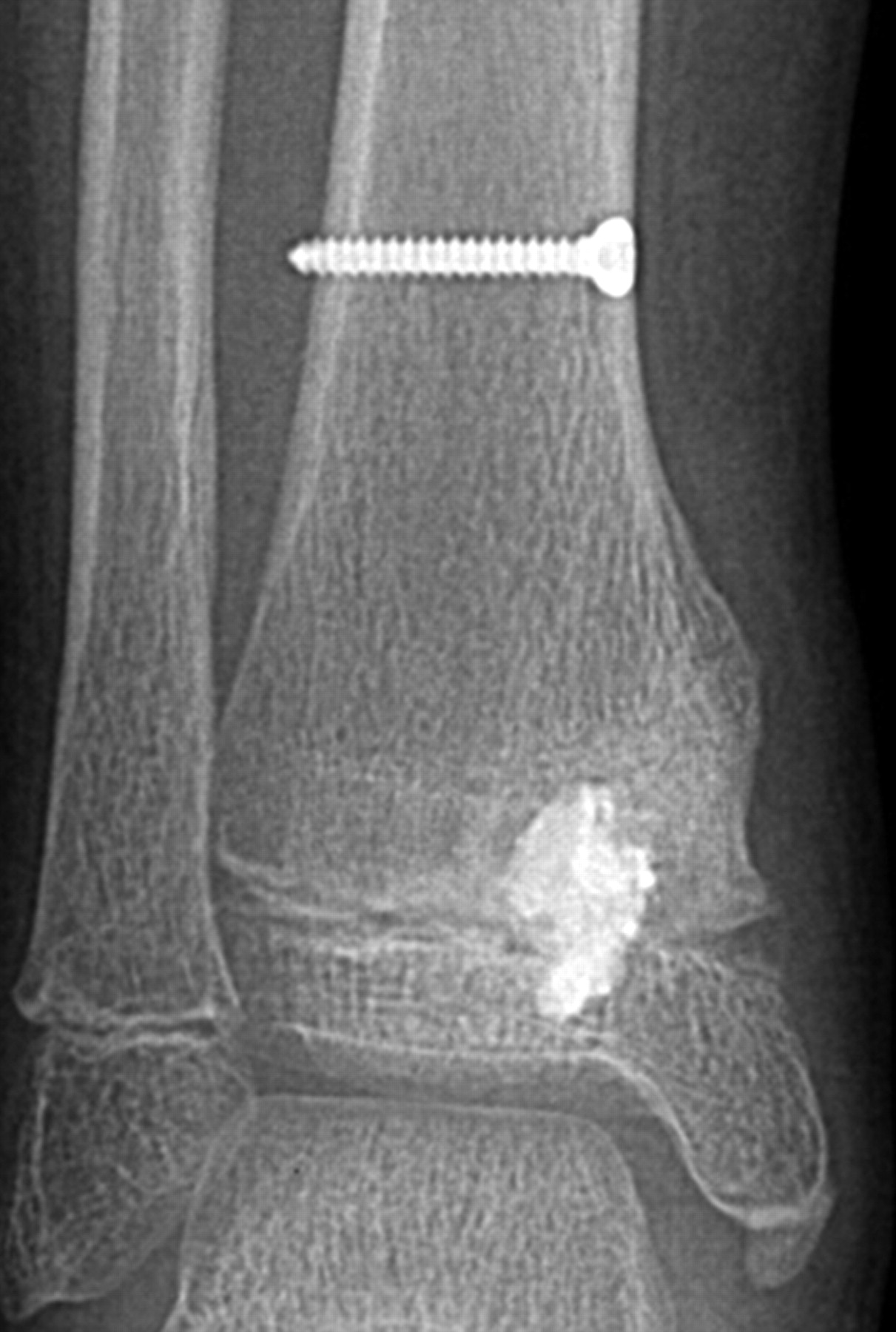 Resection Of A Physeal Bar Under Computer Assisted Guidance Bone Joint