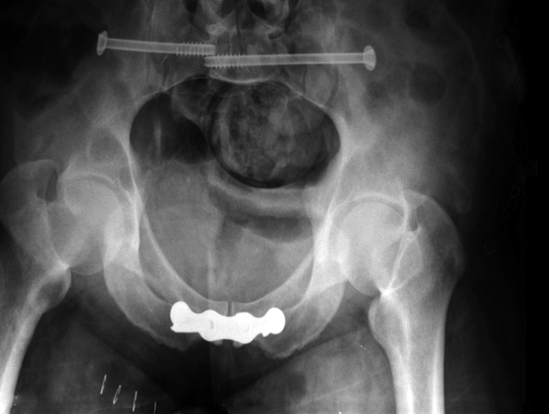 Fractures Of The Pelvis Bone Joint