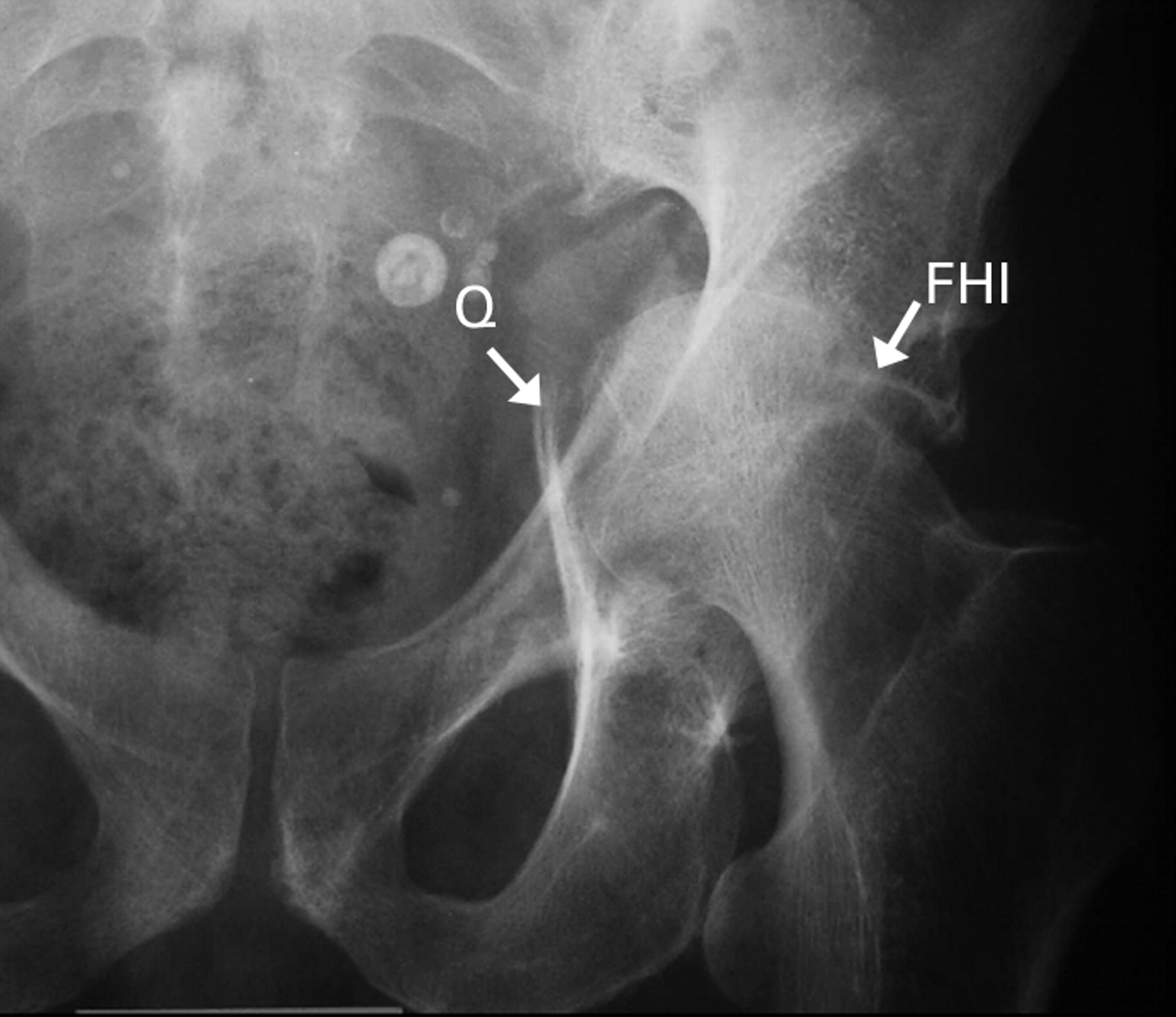 Fractures Of The Acetabulum In Patients Aged 60 Years And Older Bone