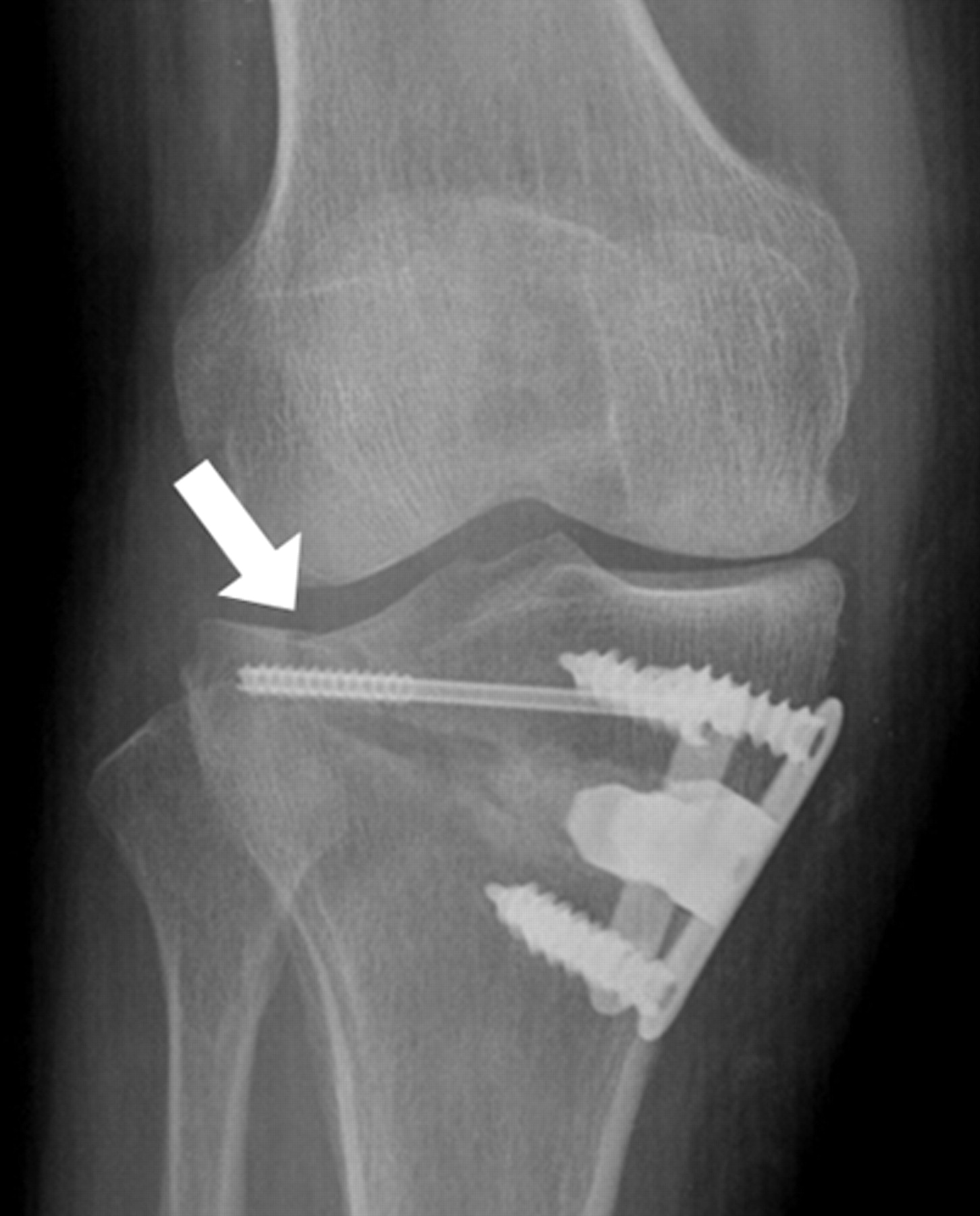 The Complications Of High Tibial Osteotomy Bone Joint