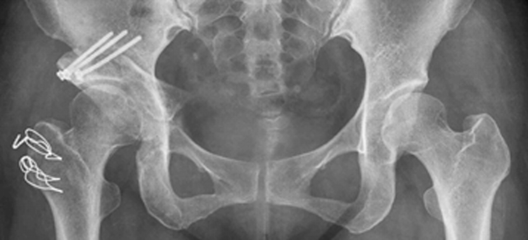 Peri Acetabular Rotational Osteotomy With Concomitant Hip Arthroscopy