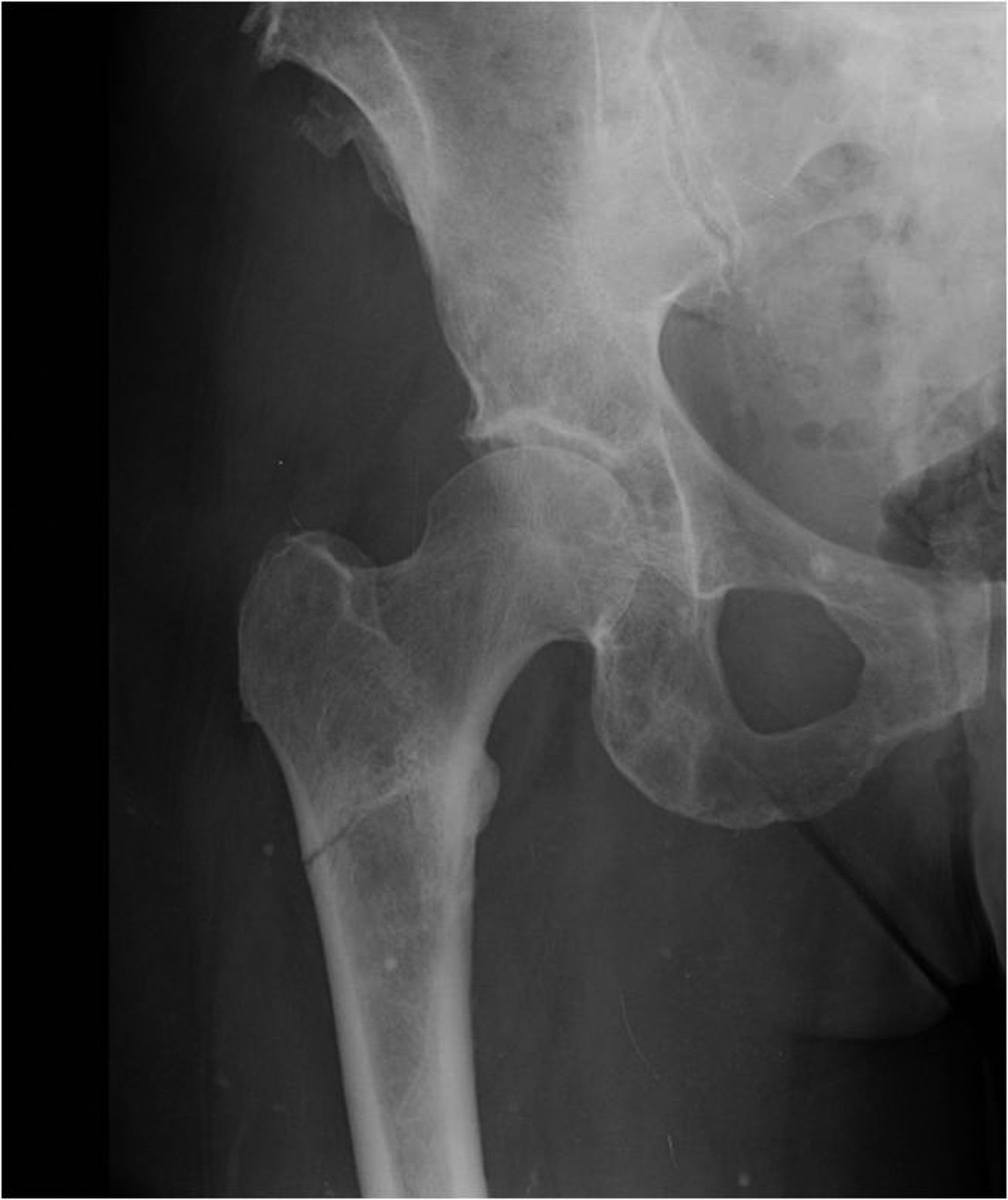 Metastatic Disease Around The Hip Bone Joint