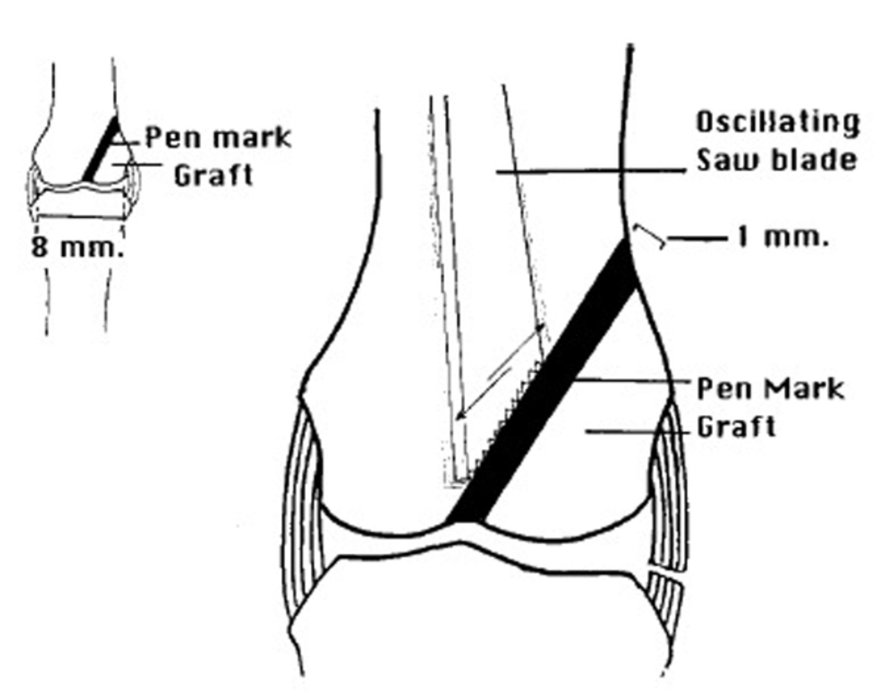 The Use Of Non Vascularised Osteochondral Autograft For Reconstruction