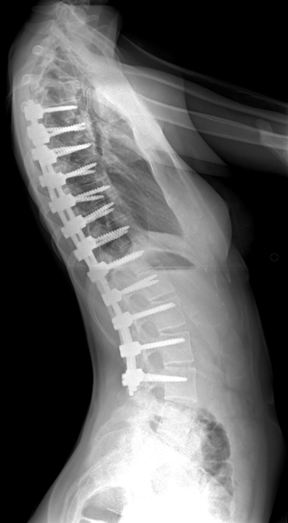 Posterior Spinal Arthrodesis For Adolescent Idiopathic Scoliosis Using