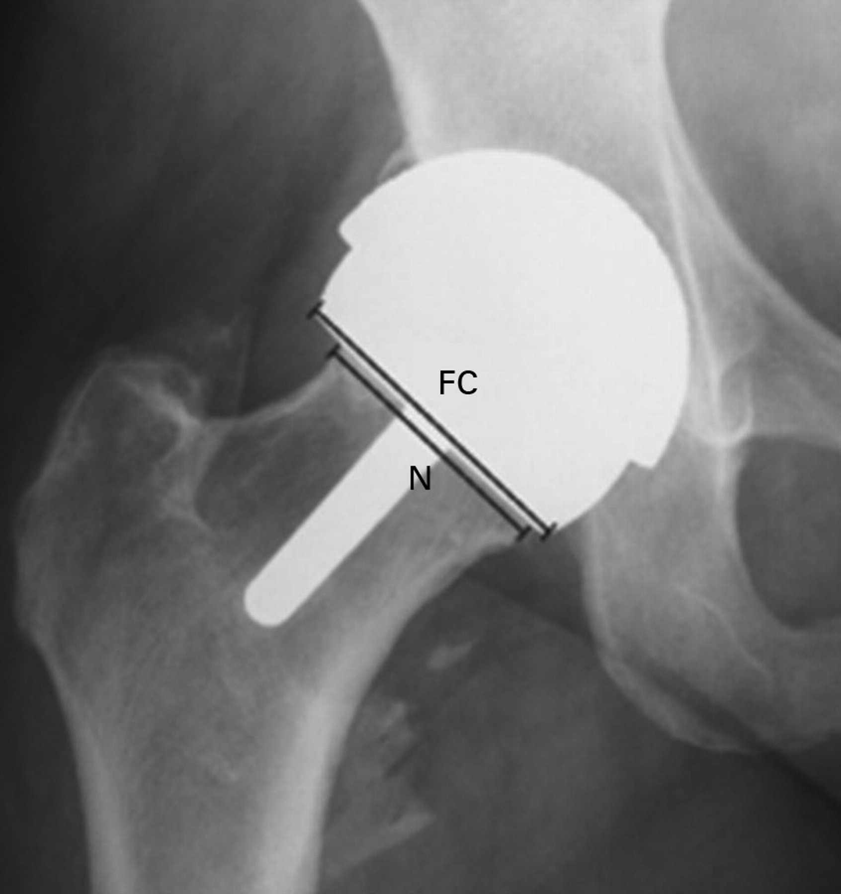 Birmingham Hip Resurfacing At A Mean Of Ten Years Bone Joint