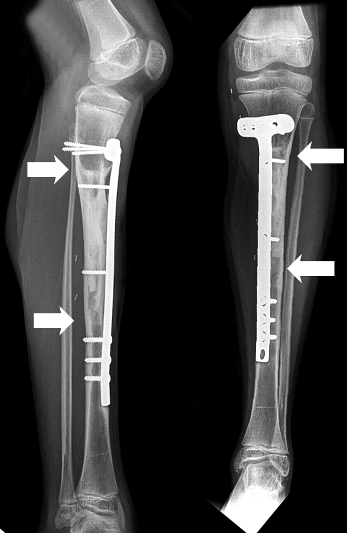 The Outcome Of The Treatment Of Diaphyseal Primary Bone Sarcoma By