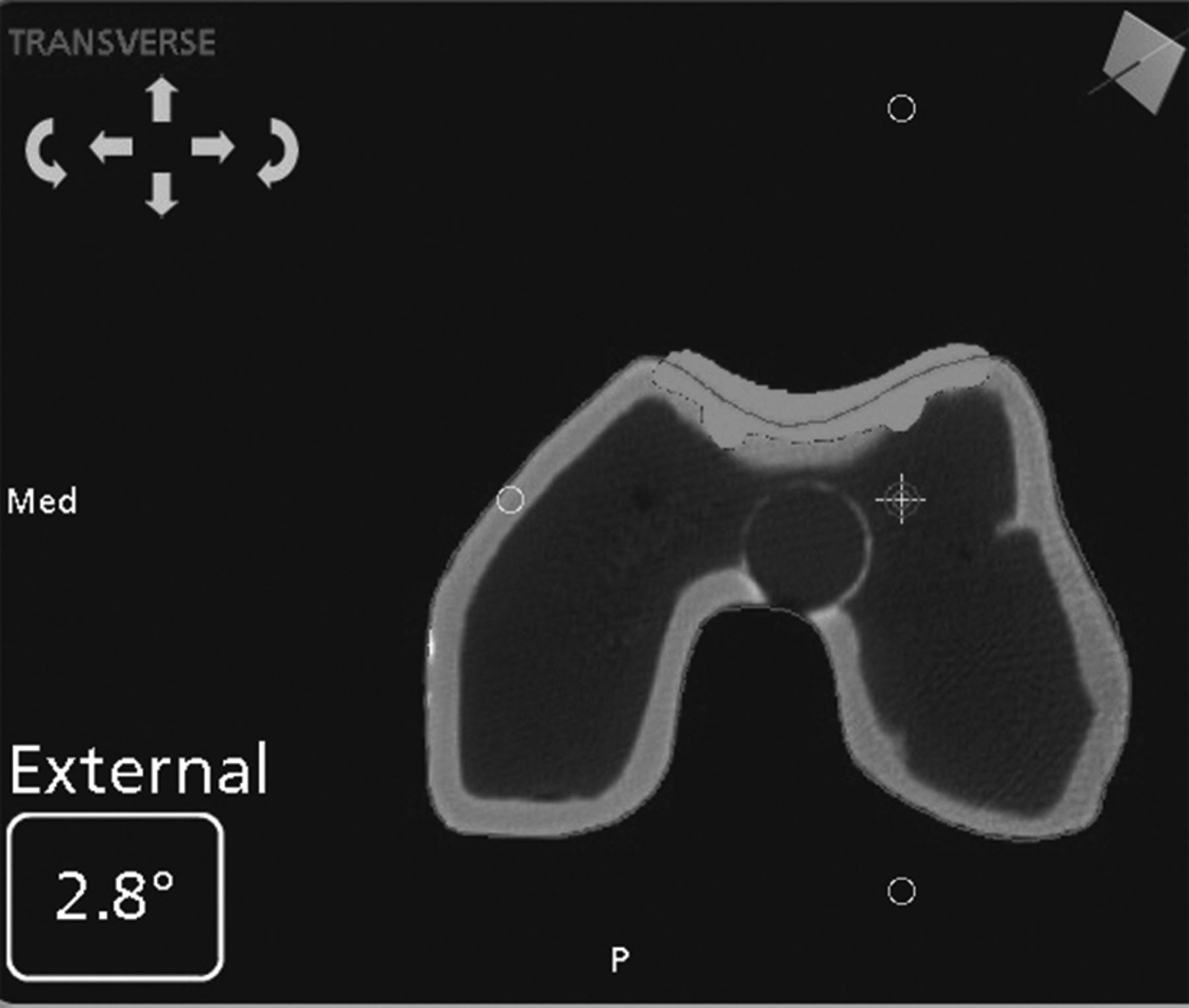 Patellofemoral Replacement Bone Joint