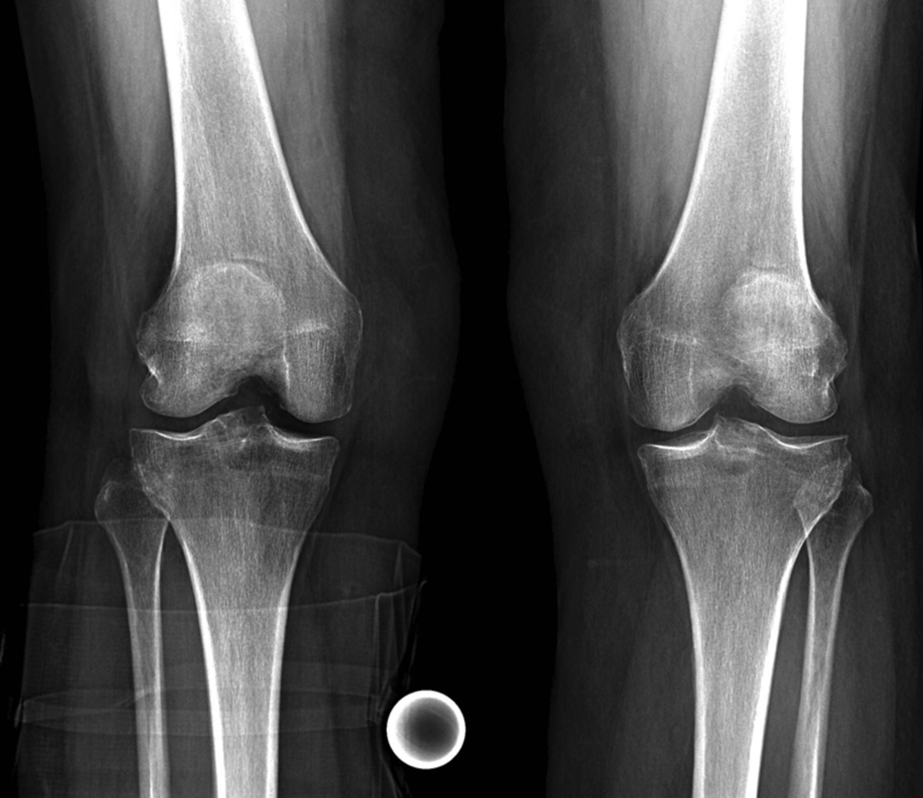 Patellofemoral Replacement Bone Joint