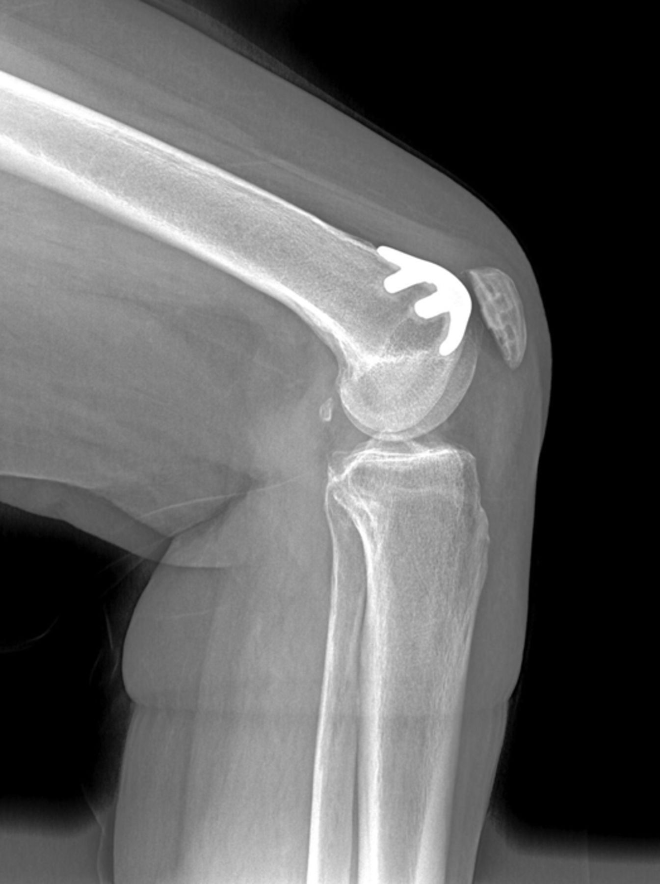 Patellofemoral Replacement Bone Joint