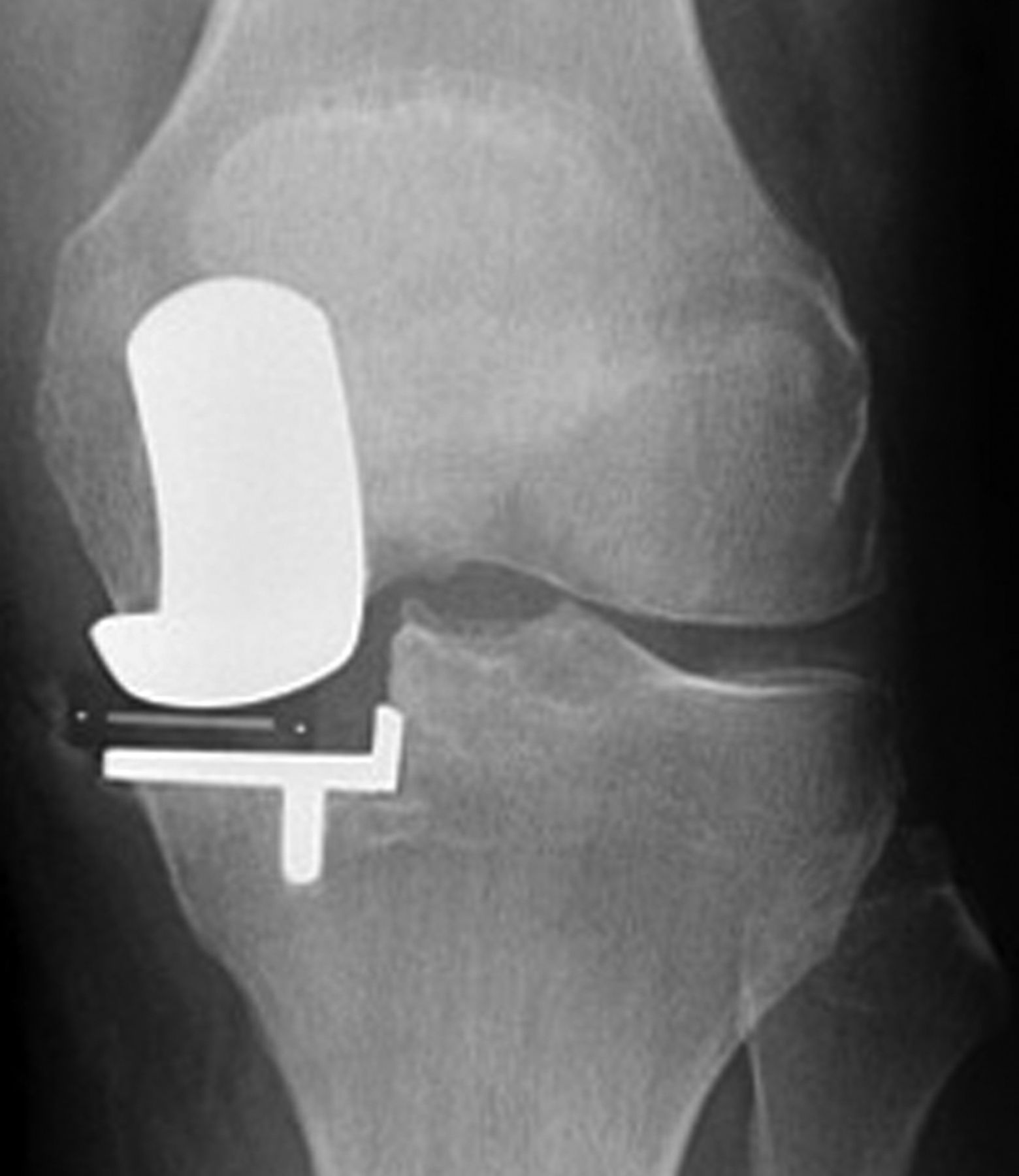 Cementless Fixation In Oxford Unicompartmental Knee Replacement Bone