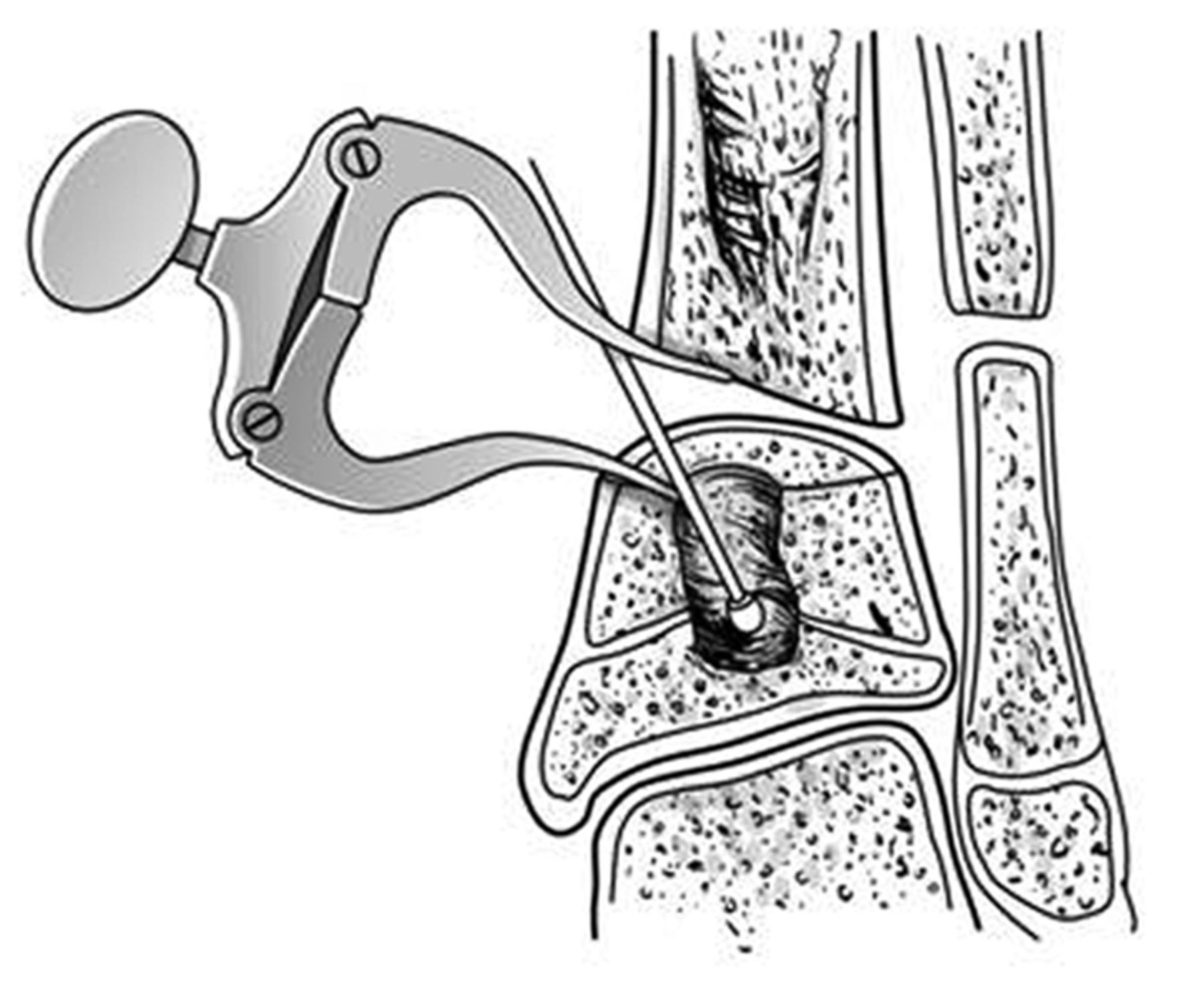 Resection Of A Physeal Bar With Complete Transverse Osteotomy At The