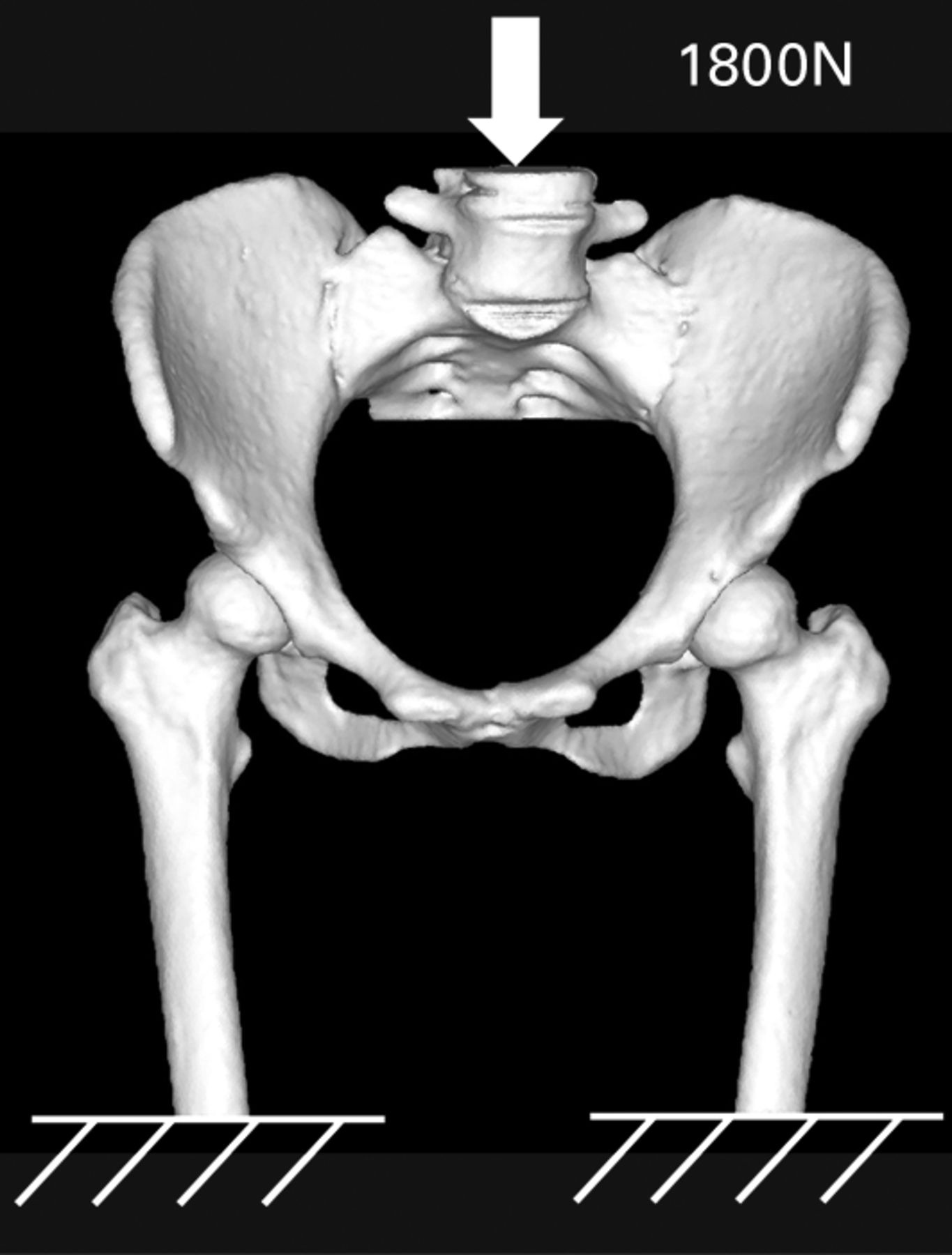 Effects Of Rotational Acetabular Osteotomy On The Mechanical Stress