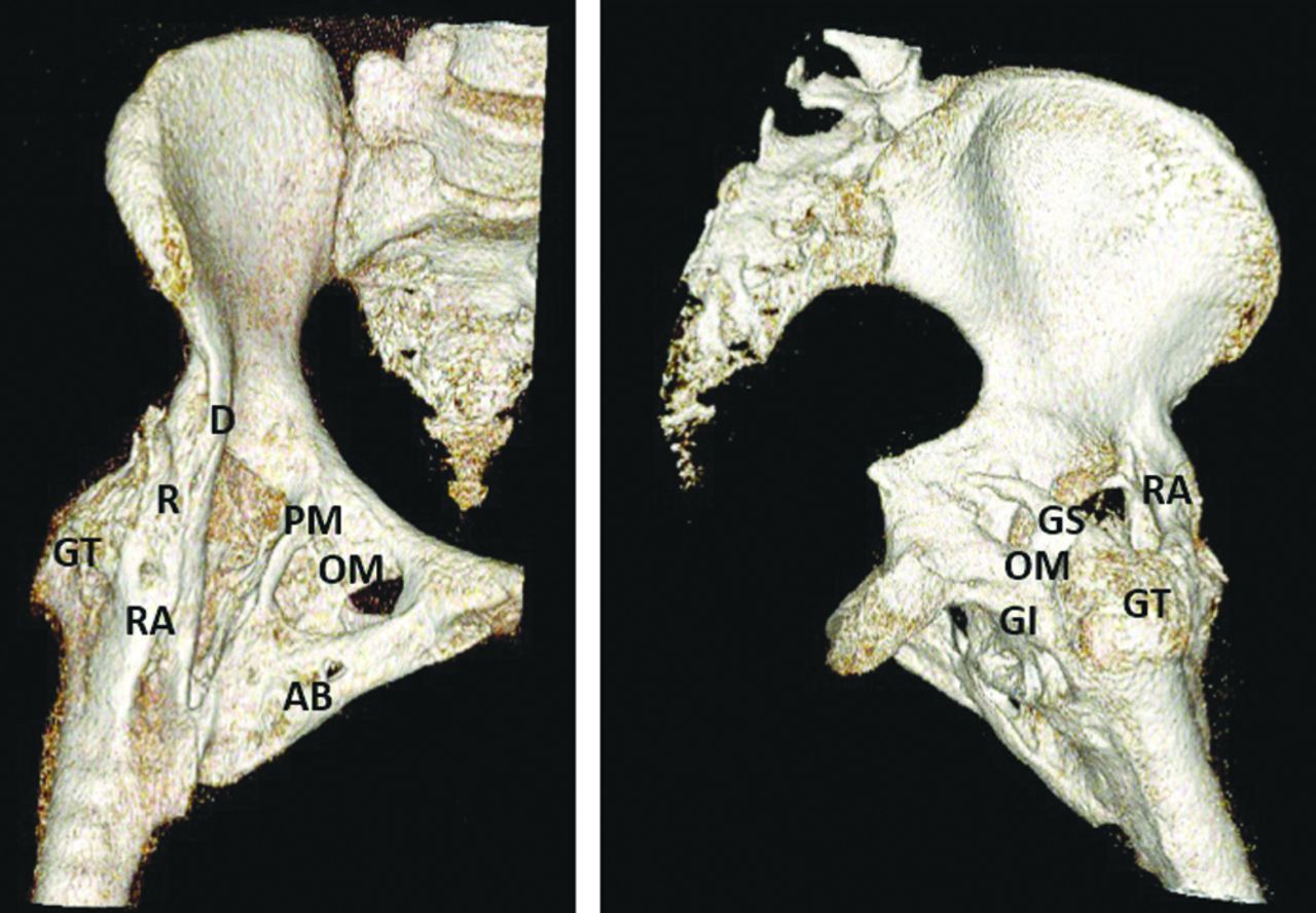 A New Classification Of Peri Articular Heterotopic Ossification Of The