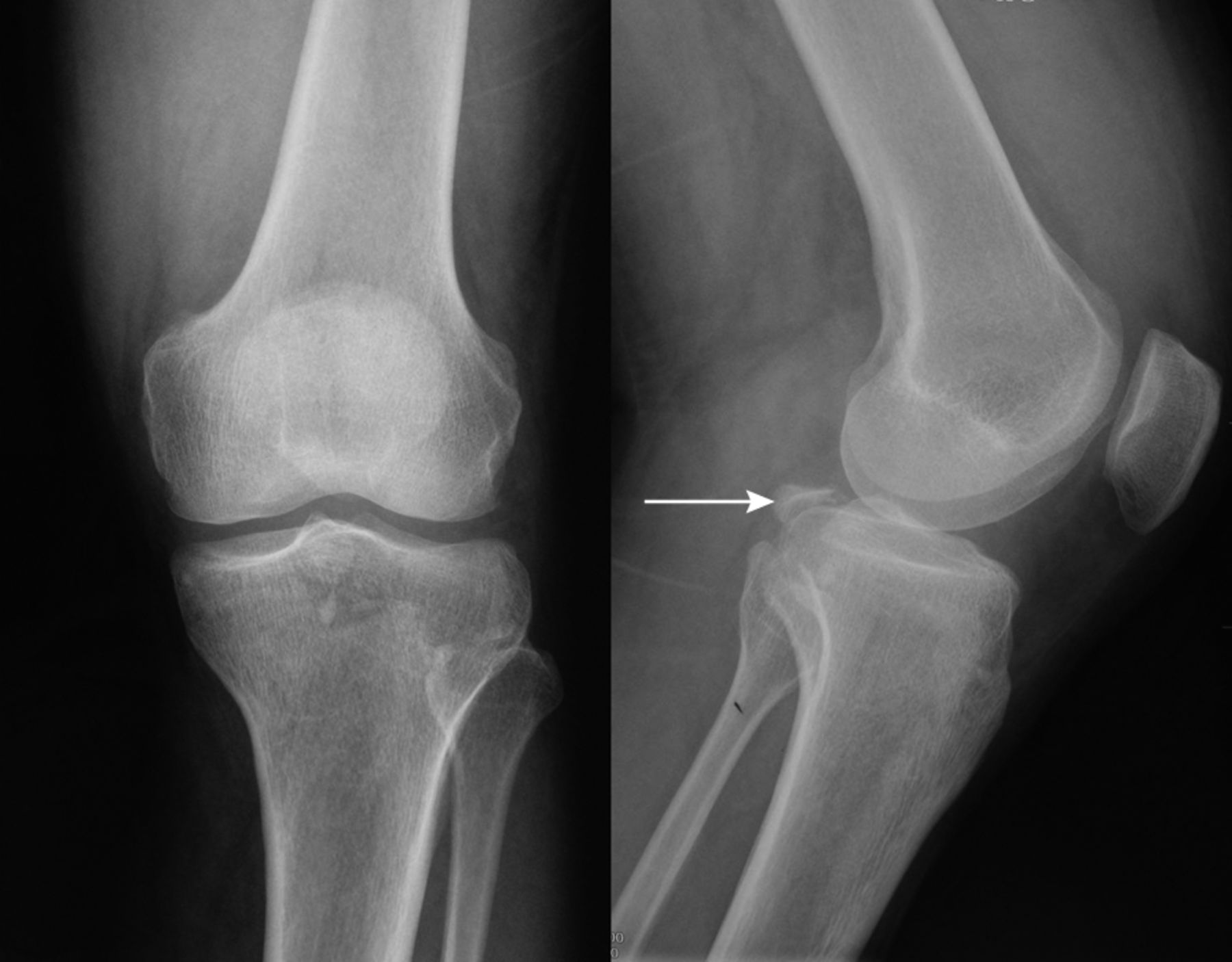 Arthroscopic Fixation Of An Avulsion Fracture Of The Tibia Involving