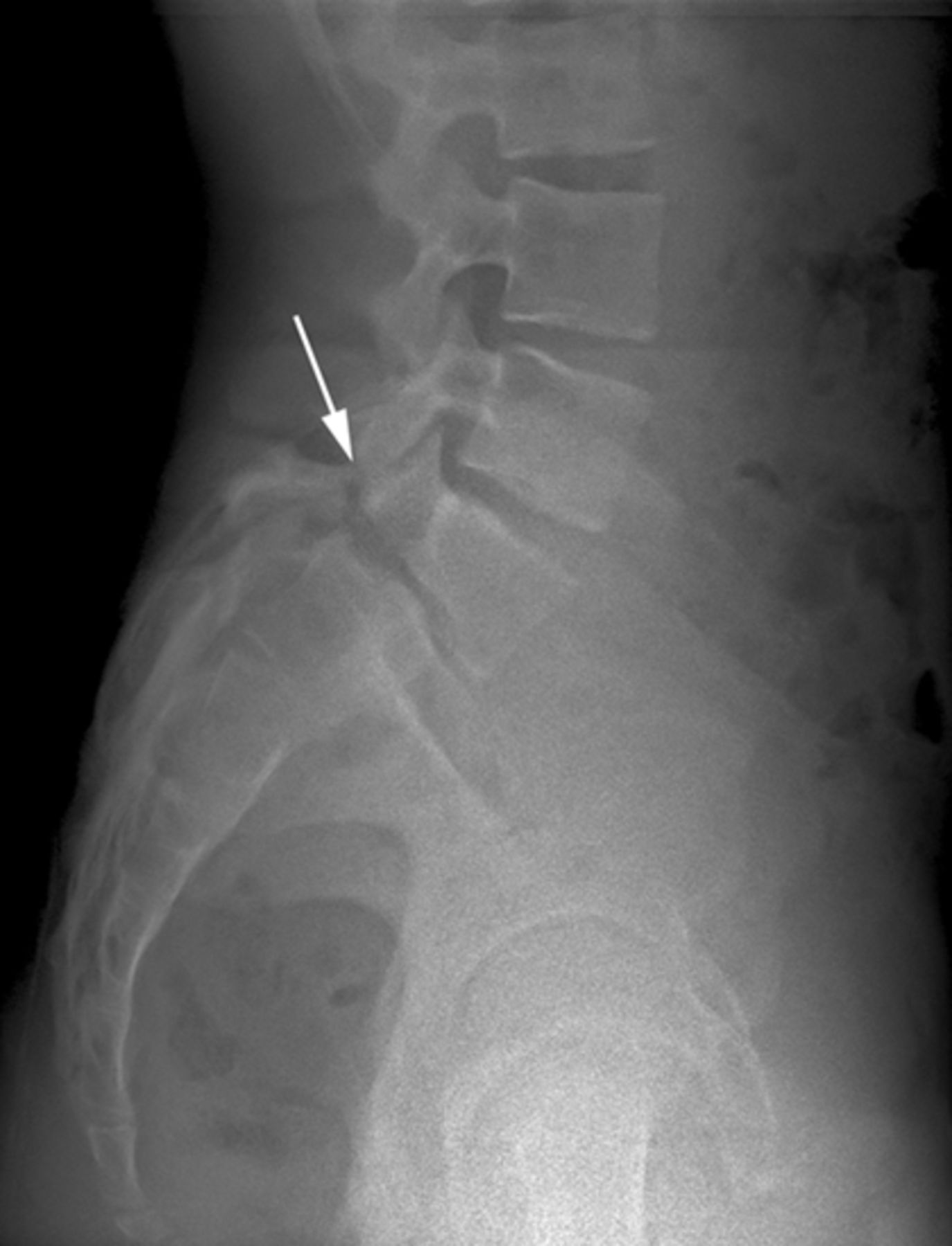 Radiographic And Functional Outcome Of Posterolateral Lumbosacral