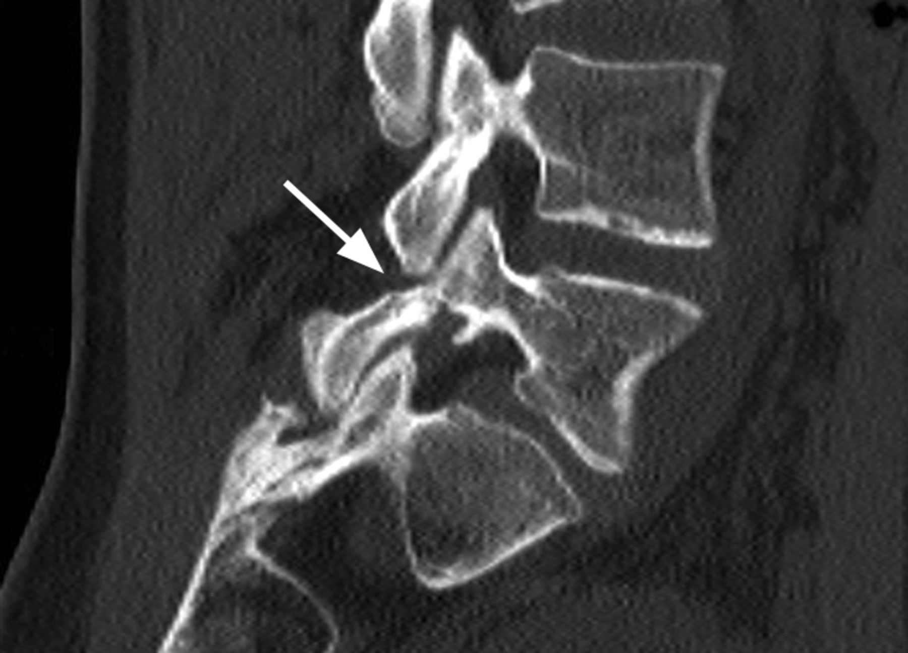 Radiographic And Functional Outcome Of Posterolateral Lumbosacral