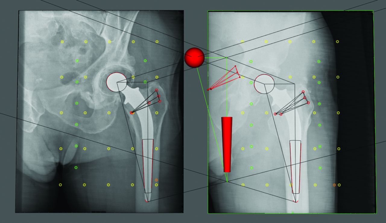 Comparison Of Femoral Component Migration Between Refobacin Bone Cement