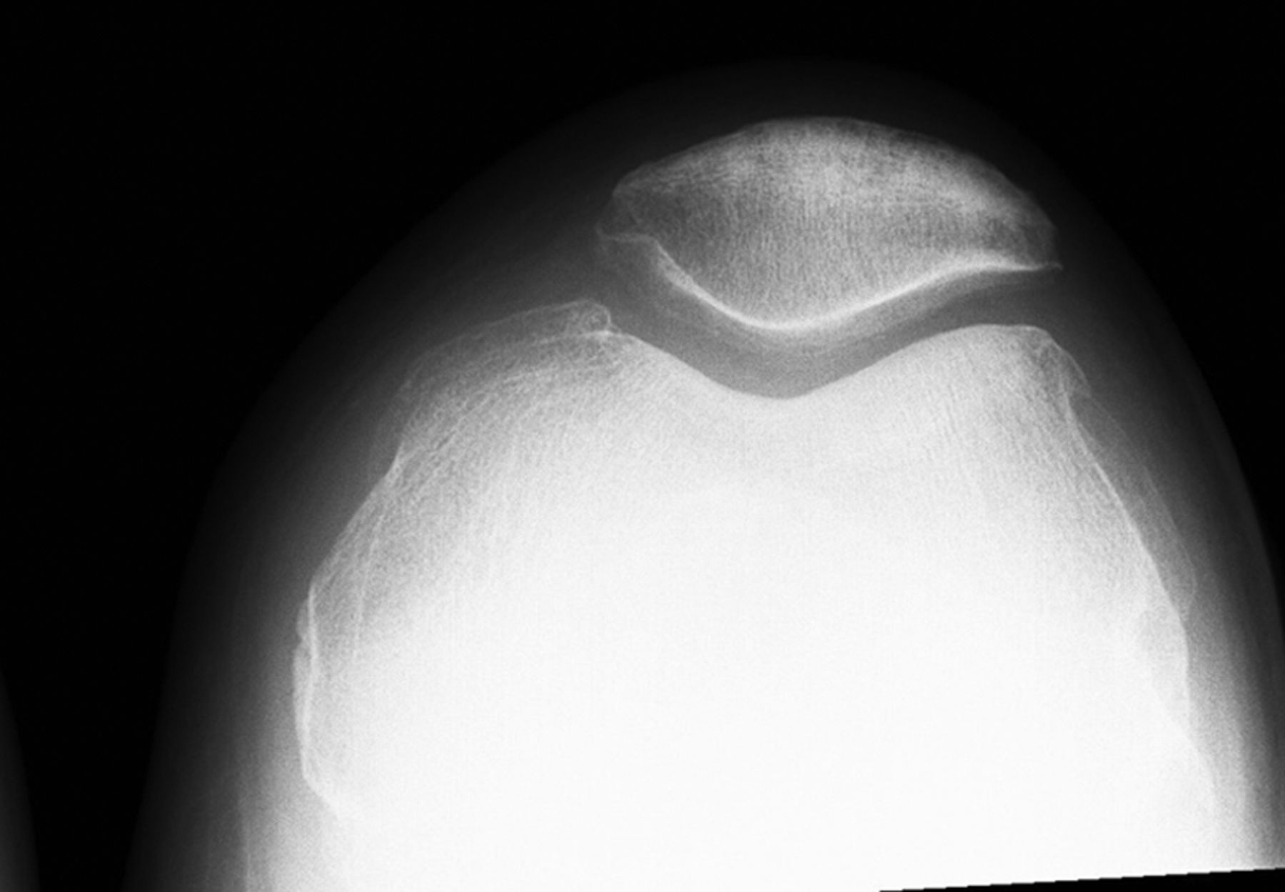 Fig. 1 
          Pre-operative radiograph of lateral
chondral lesion in the patellofemoral joint that was treated with
a medial unicompartmental arthroplasty.
        