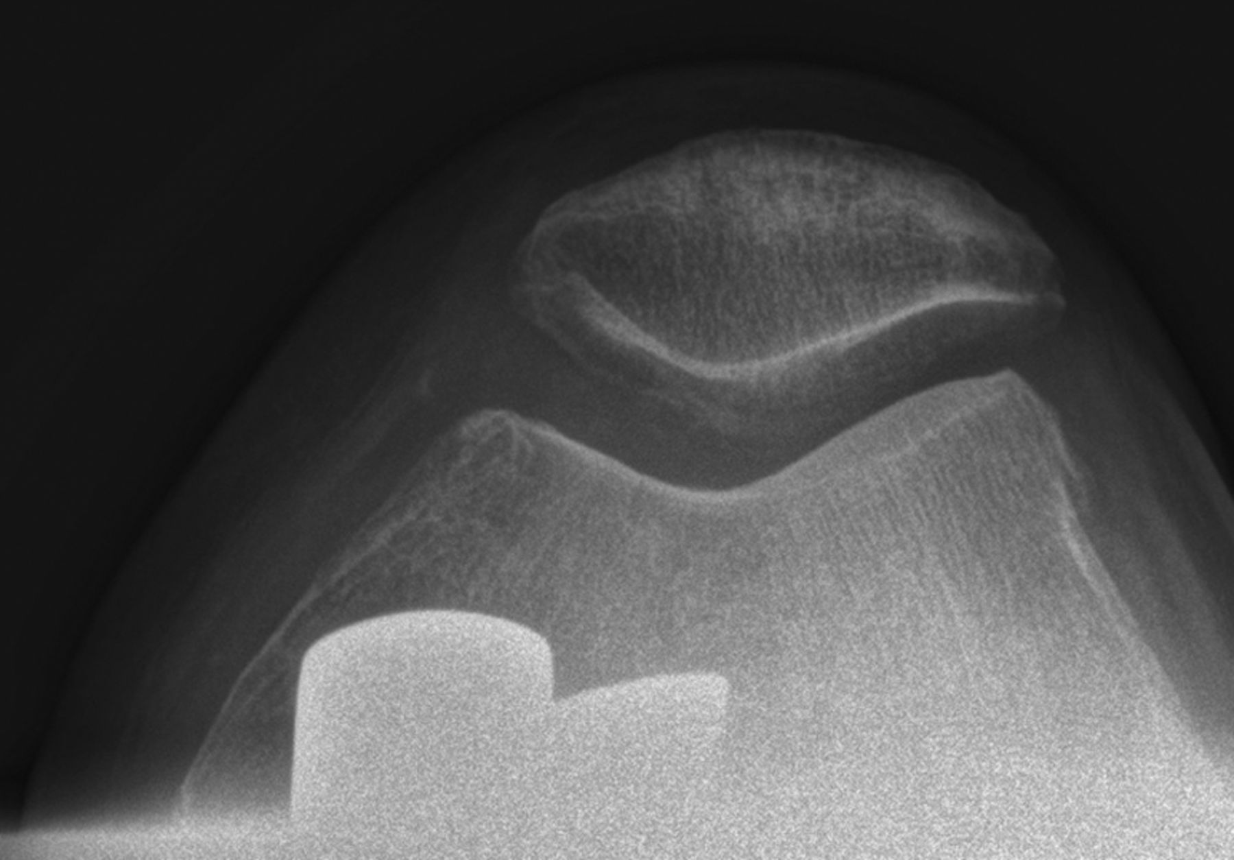 Fig. 2 
          Post-operative radiograph lateral chondral
lesion in the patellofemoral joint that was treated with a medial
unicompartmental arthroplasty at latest follow-up.
        