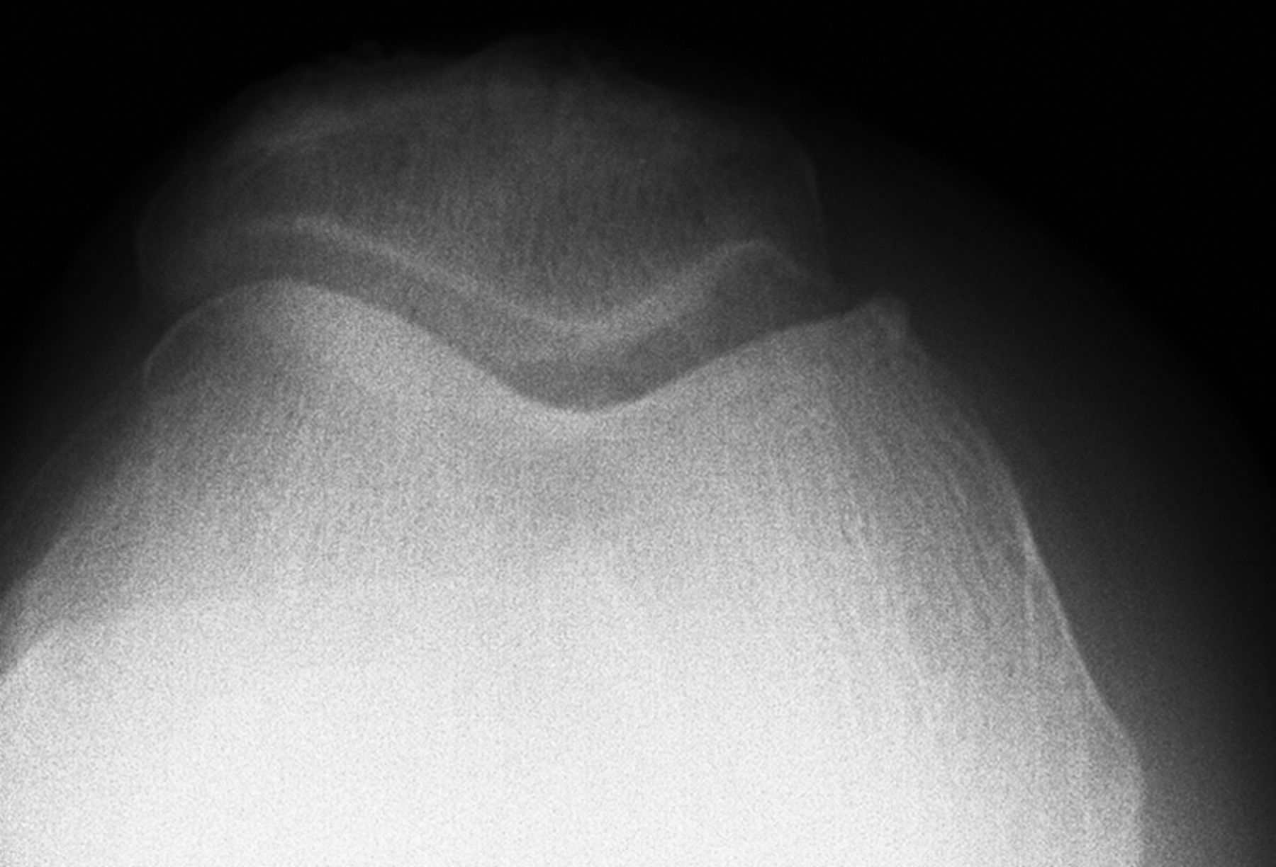 Fig. 3 
          Pre-operative radiograph of medial patellar
cartilage lesion that was treated with a medial unicompartmental arthroplasty.
        