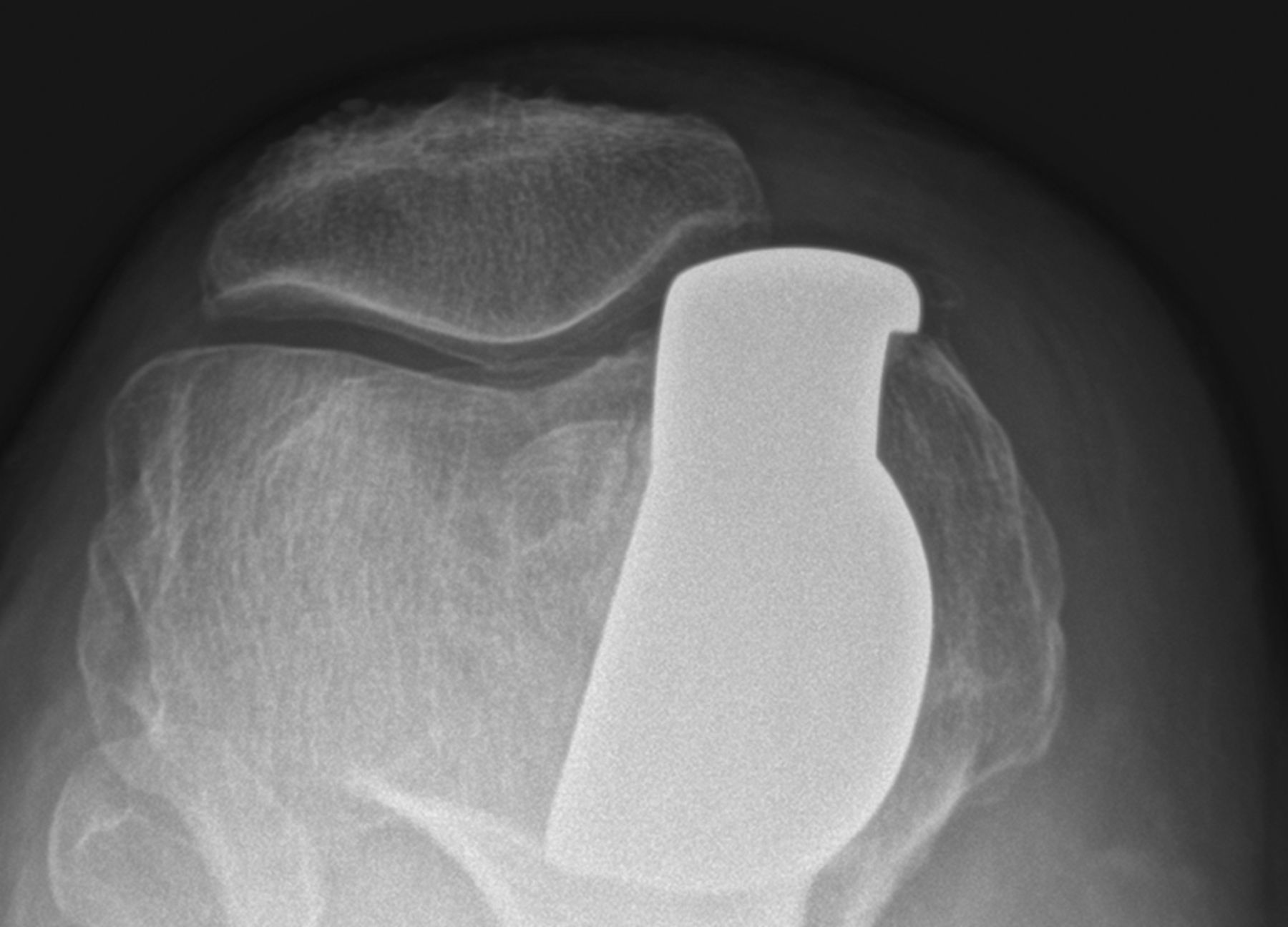 Fig. 4 
          Post-operative radiograph of medial
patellar cartilage lesion treated with medial unicompartmental arthroplasty
at latest follow-up.
        