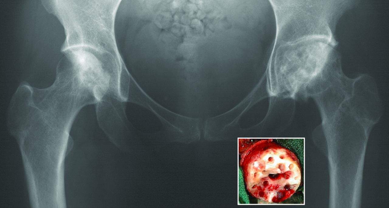 Hip Resurfacing For Osteonecrosis Bone Joint