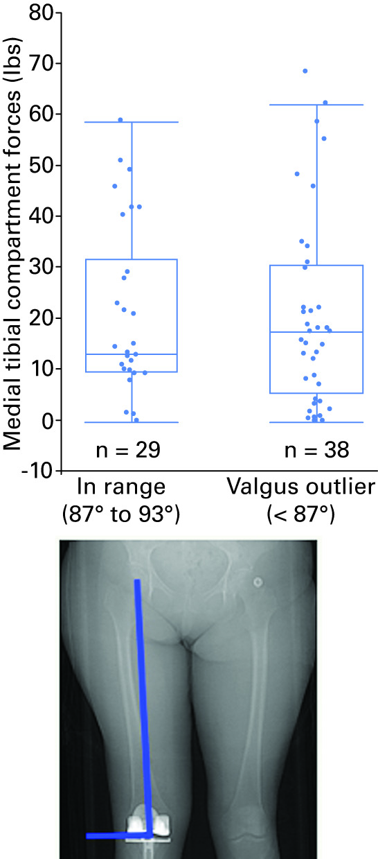 Do Varus Or Valgus Outliers Have Higher N Forces In The Medial Or