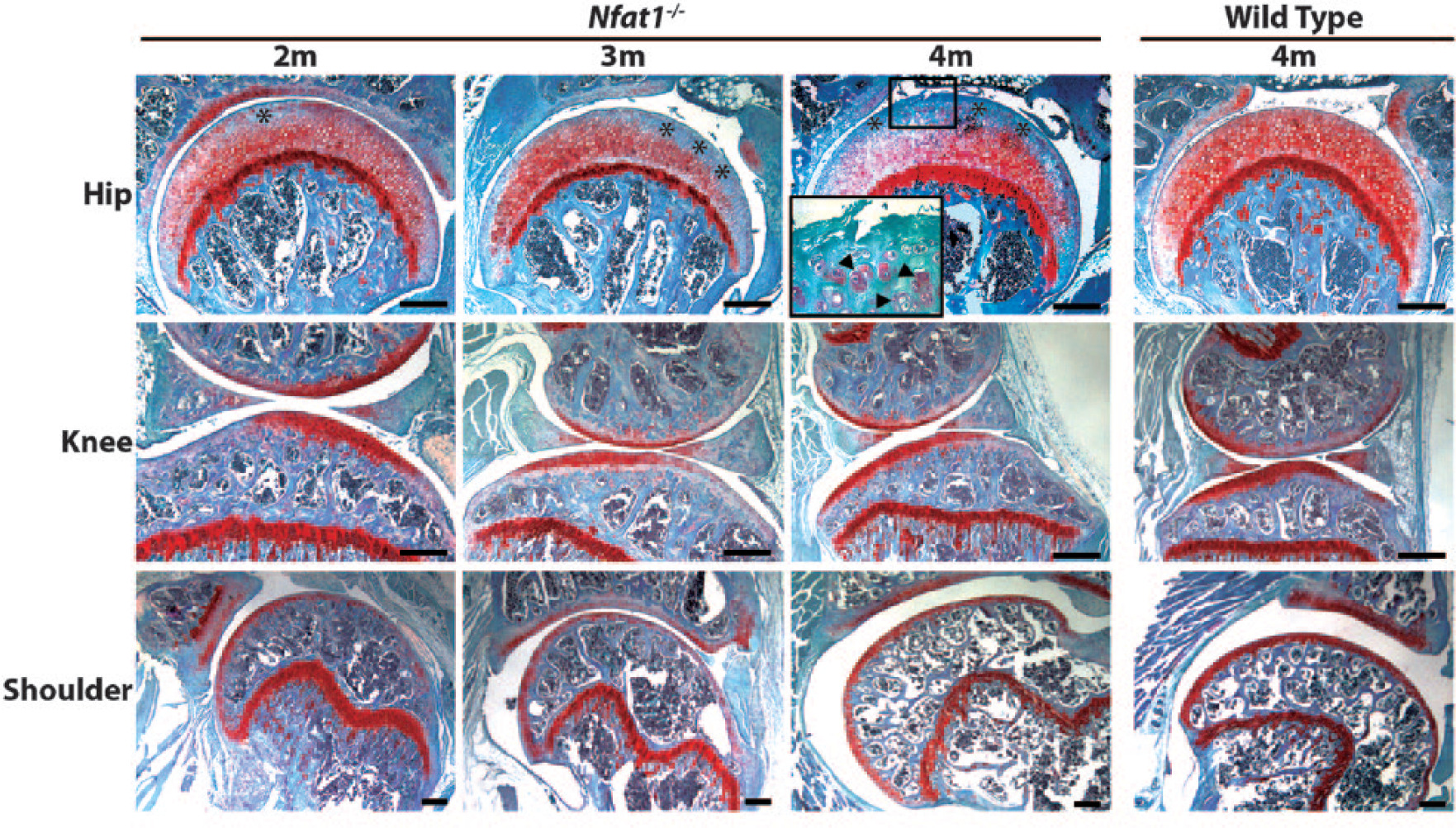 Fig. 1 
            Representative photomicrographs of hip, knee, and shoulder joints of two-, three-, and four-month-old female Nfat1-/- mice and four-month-old female wild-type (WT) mice showing that the early osteoarthritis (OA) phenotype appears in the Nfat1-/- hip (femoral head), but not in the Nfat1-/- knees or shoulders. *indicates the area with loss of Safranin-O staining and arrowheads in the enlarged image from the rectangular box denote chondrocyte clustering (a typical feature of OA) in an Nfat1-/- femoral head. Safranin-O and fast green stain, scale bar = 200 µm.
          