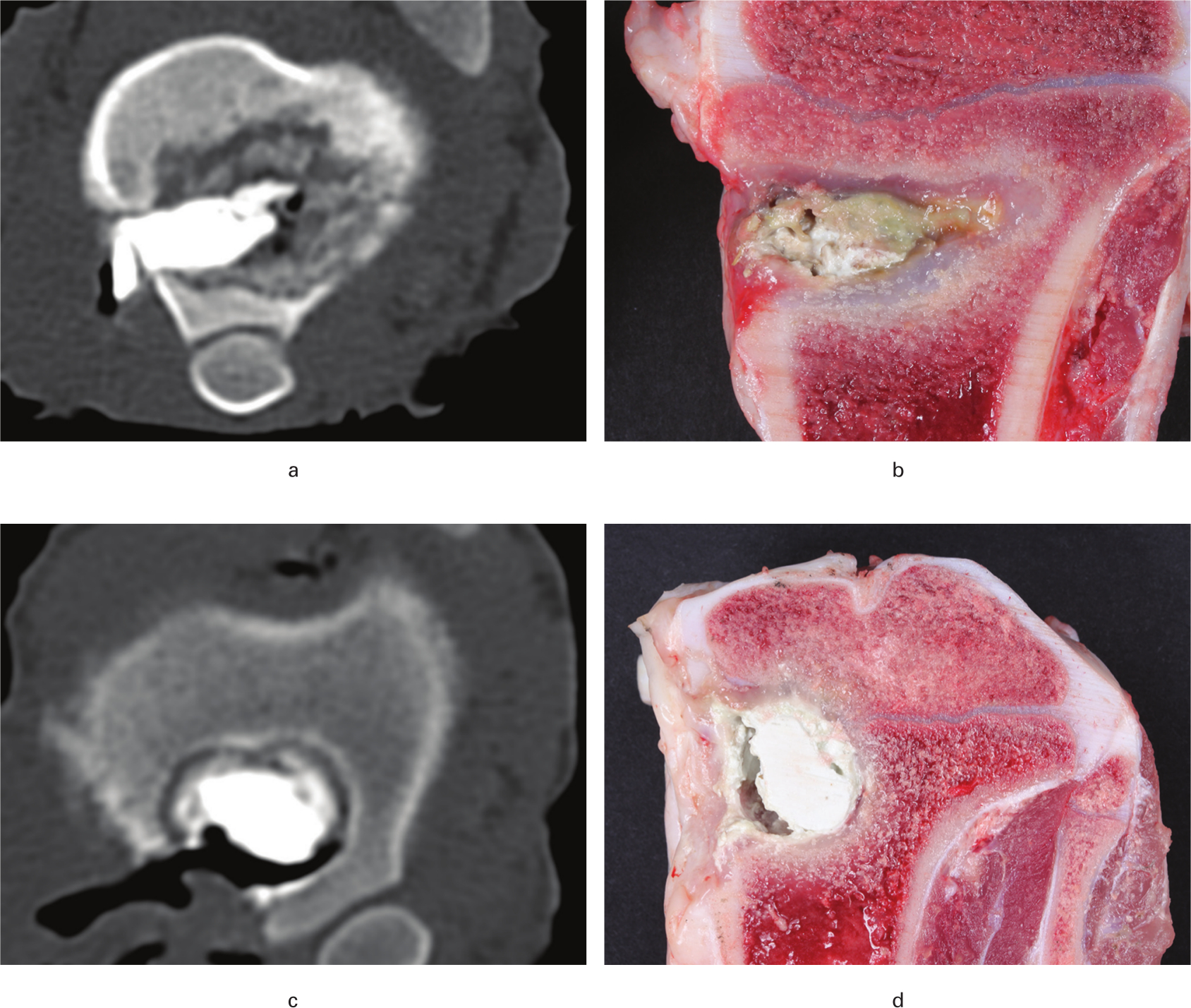 Fig. 1 
            CT scans (cranio-caudal direction) and macroscopic images obtained ten and 12 days after revision surgery in a porcine model of Staphylococcus aureus osteomyelitis. Pigs were treated with either limited debridement (A + B) or extensive debridement (C + D) followed by injection of CERAMENT|G into the bone voids. a) Osteomyelitis with osteolysis and irregular borders of the lesion. b) CERAMENT|G surrounded by pus and fibrosis. c) Regular sclerotic border of the bone void. d) CERAMENT|G surrounded by a rim of fibrosis.
          
