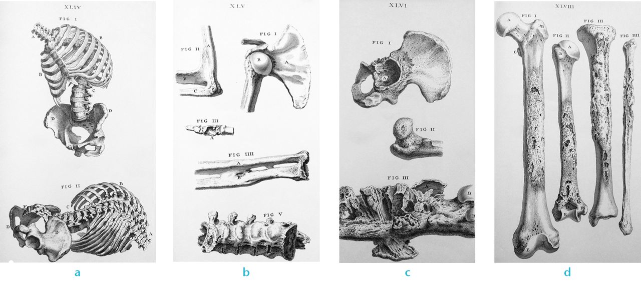 Fig. 4 
            Original anatomical illustrations of the osteology of William Cheselden’s work entitledOsteographia, or the Anatomy of the Bones (1733).7 The illustrations show in Figure 4a – Parts 1 &
 2 : kyphoscoliosis of the spine. Figure 4b – Part 1: dislocation of the humeral head after a scapular fracture; Part 2: congenital ankylosis of the elbow; Part 3: osteomyelitis of the thumb in tuberculosis, Part 4: synostosis between the radius and ulna after an antebrachial fracture; Part 5: ankylosis of the lumbar spine. Figure 4c – Parts 1 &
 2: destruction and perforation of the acetabulum by an abscess of the hip joint; Part 3: osteomyelitis of the femur. Figure 4d – Parts 1 to 4: destruction of bone in an advanced stage of syphilis. Authors’ collection.
          