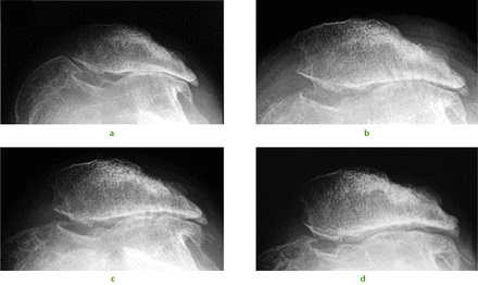Fig. 1 
            A 34-year-old female presented with recurrent dislocation of her patella as an adolescent. Radiographs were taken a) pre-operatively, and b) immediately post-operatively showing evidence of subchondral drilling. Radiographs at c) six months and d) two years showed a progressive reappearance of the lateral patellofemoral articulation.
          