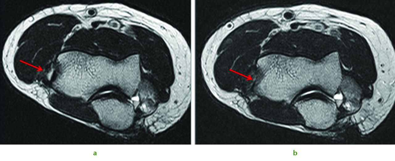 Fig. 6 
            A 57-year-old man presented with a recalcitrant lateral epicondylitis (tennis elbow). Figure 6a – pre-operative MRI. Figure 6b – MRI scan at three months showing satisfactory healing.
          